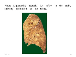 Figure - Liquefactive necrosis. An infarct in the brain,
showing dissolution of the tissue.
2/21/2023 59
 