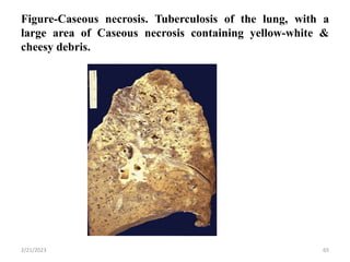 Figure-Caseous necrosis. Tuberculosis of the lung, with a
large area of Caseous necrosis containing yellow-white &
cheesy debris.
2/21/2023 65
 