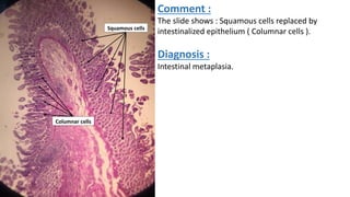 Comment :
The slide shows : Squamous cells replaced by
intestinalized epithelium ( Columnar cells ).
Diagnosis :
Intestina...