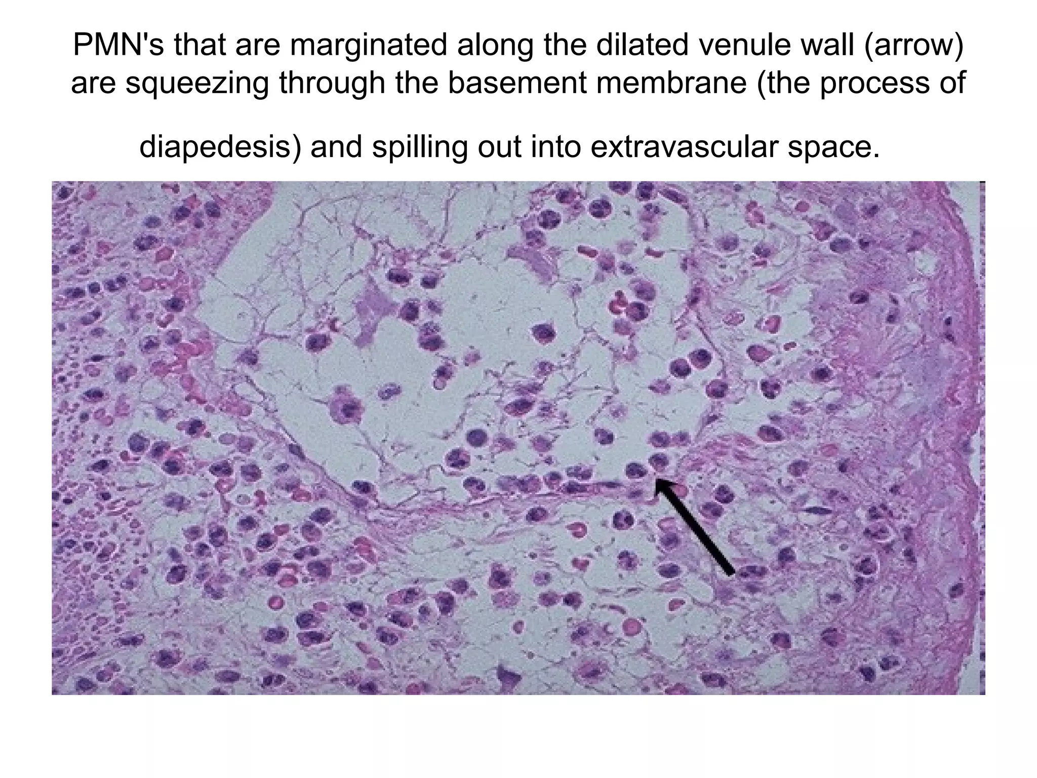 • 26. Lungs:
anthracotic pigment in
a patient with "black
lung" disease
• Note the heavy
deposition of black
pigment in this lung (see
arrow) from a patient
with coal worker s
pneumoconiosis (dust-
related pulmonary
disease). The large
spaces in the apex of
this lung represent
emphysema secondary
to damage associated to
the respiratory
bronchioles from the
excess anthracotic
pigment. "Black lung"
disease is a crippling
disease and is associated
with an increased
incidence of TB.
 