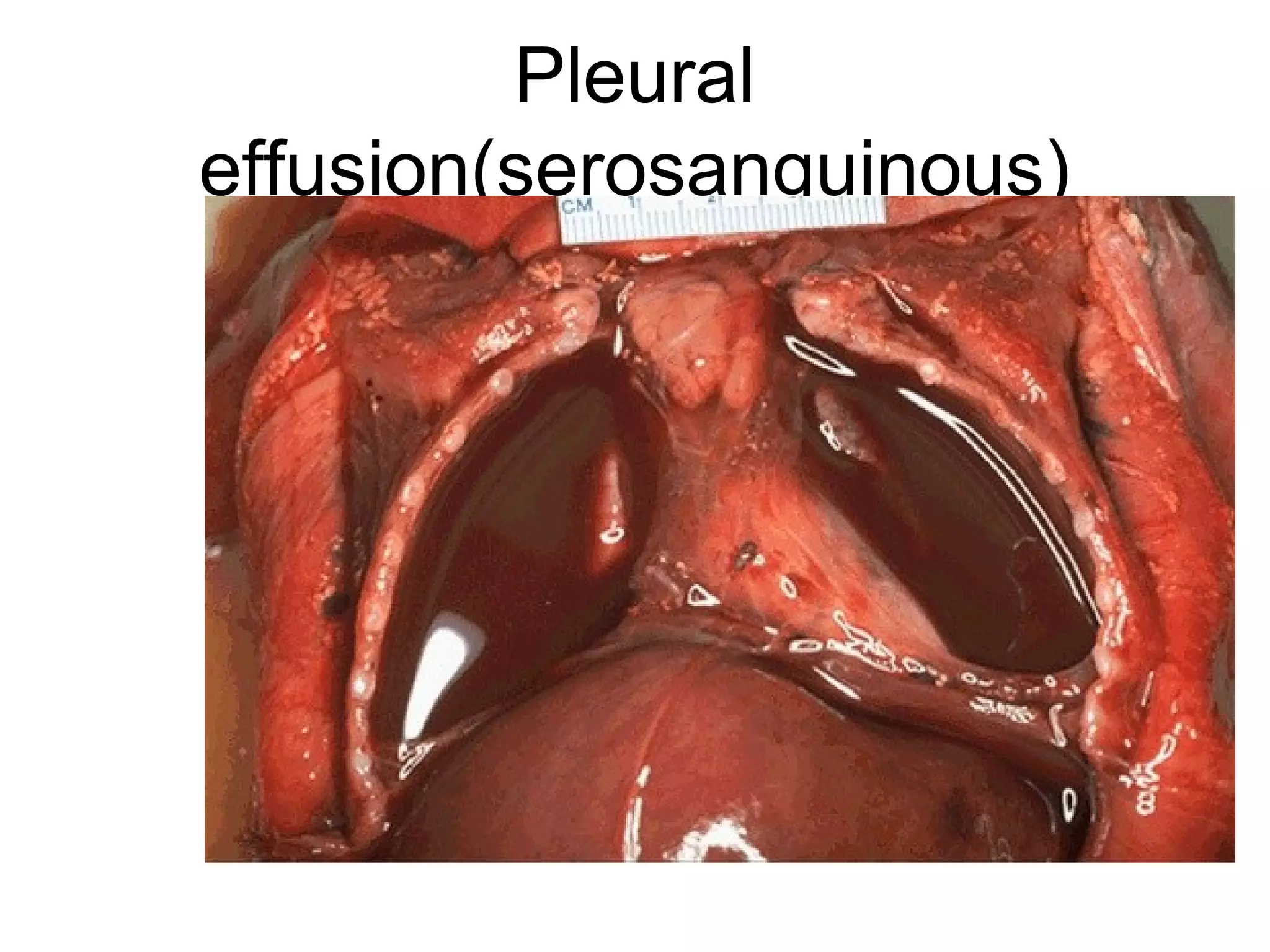 Liver hemochromatosis
 