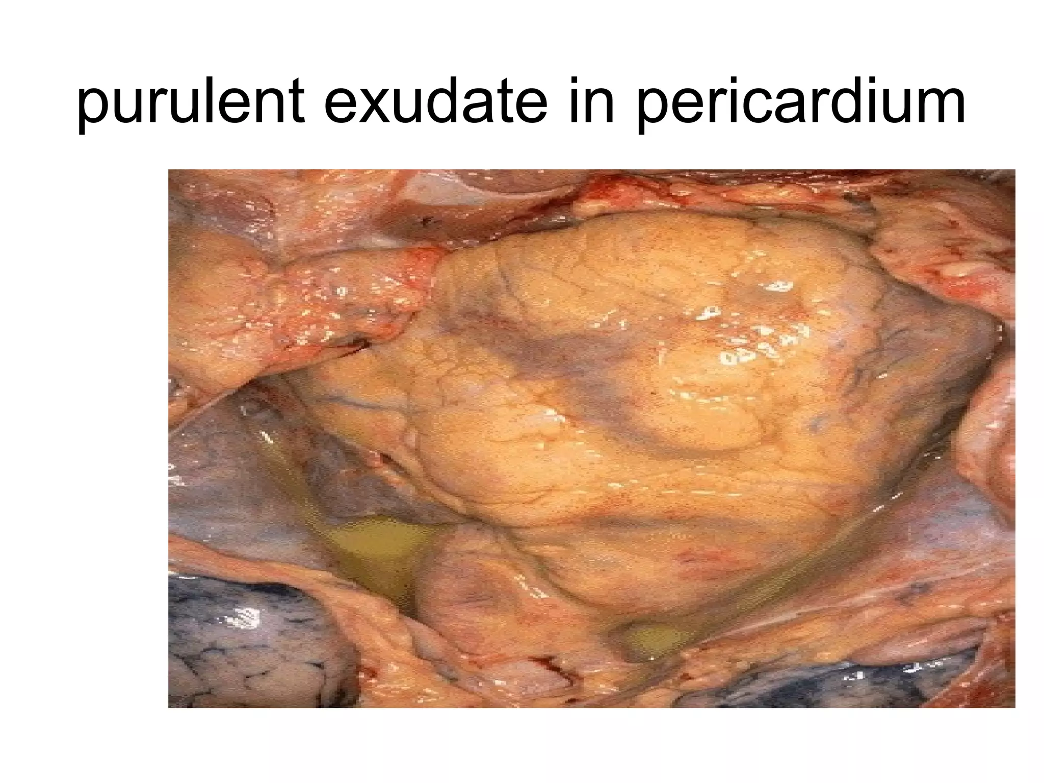 A Prussian blue reaction is seen in this iron stain of the liver to demonstrate large
amounts of hemosiderin that are present within the cytoplasm of the hepatocytes and
Kupffer cells. Ordinarily, only a small amount of hemosiderin would be present in the
fixed macrophage-like cells in liver, the Kupffer cells, as part of iron recycling.
 