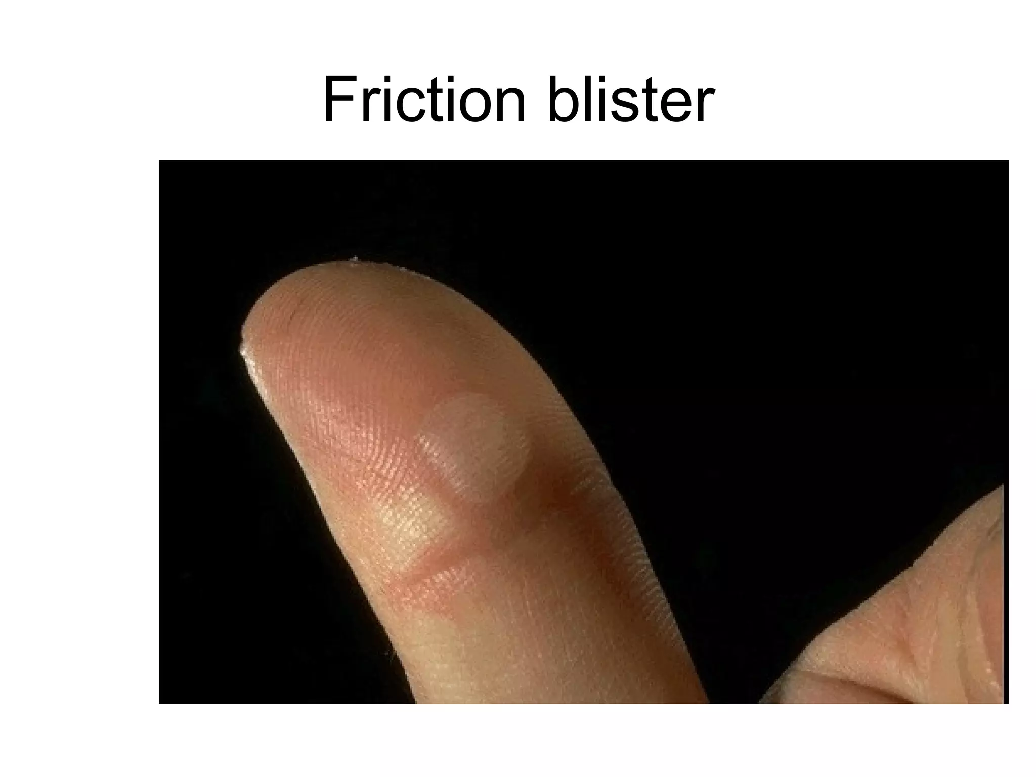 Some of these skeletal muscle fibers here show atrophy, compared to normal fibers. The
number of cells is the same as before the atrophy occurred, but the size of some fibers
is reduced. This is a response to injury by "downsizing" to conserve the cell. In this case,
innervation to the small, atrophic fibers was lost. (This is a trichrome stain.)
 