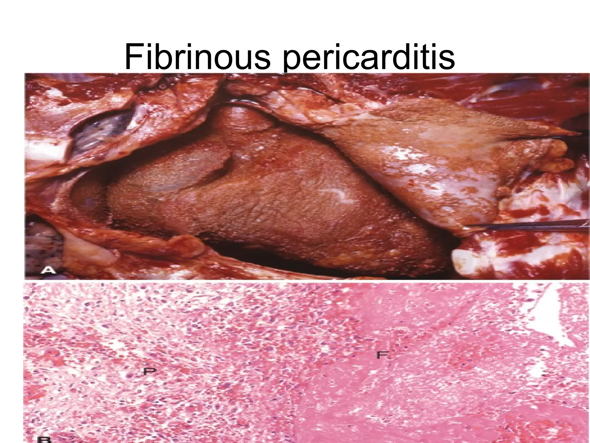 Picture 2 : Dry gangrene on hand
 