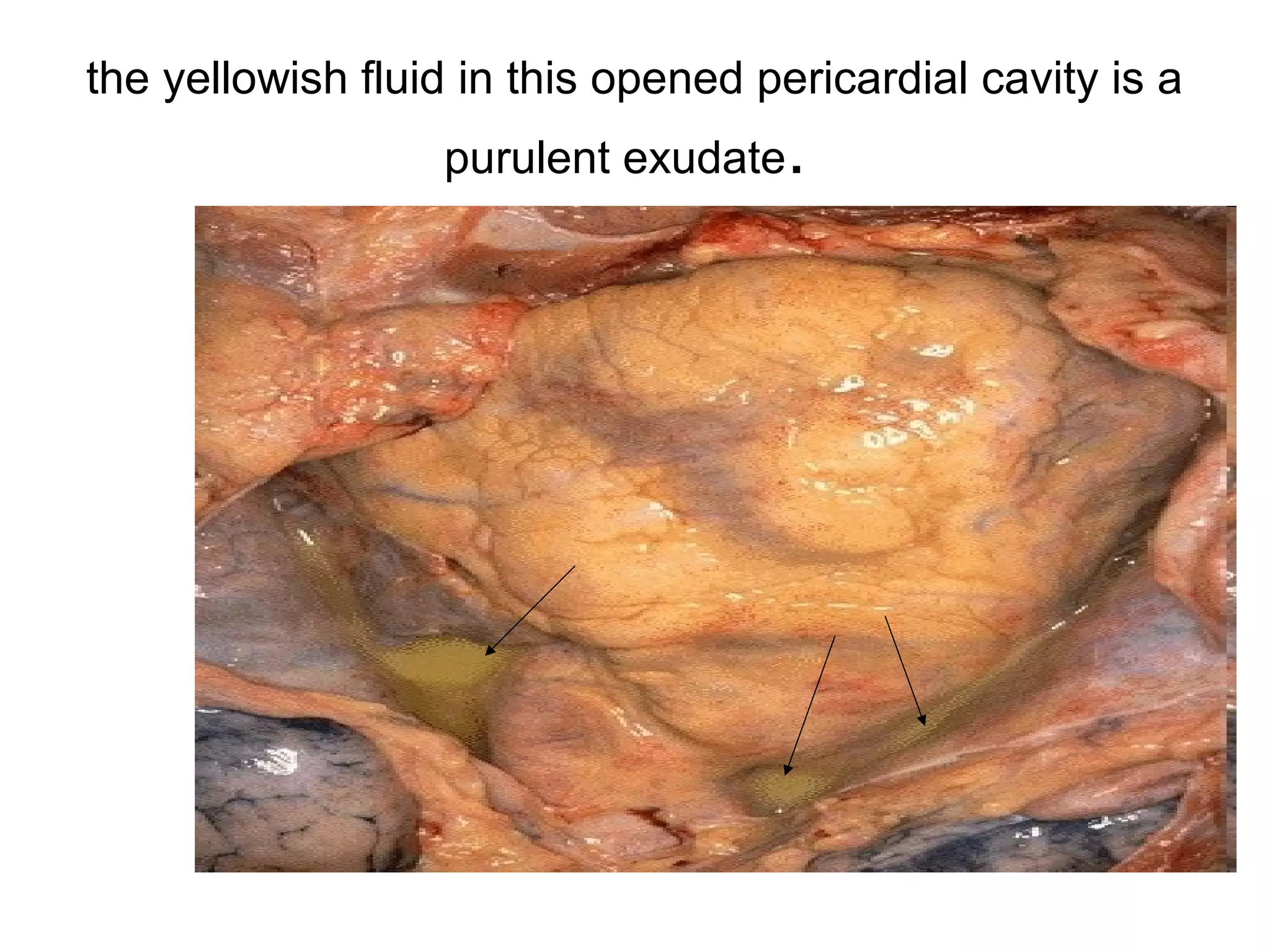 Inflammatory cells.neutrophils , macrophages
,lymphocytes
 