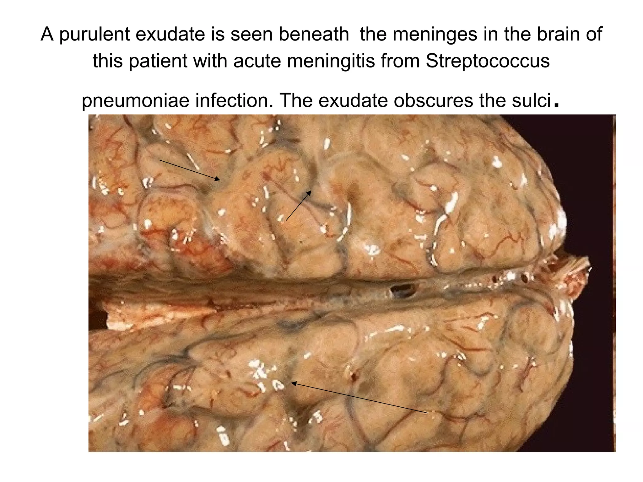 The neutrophils are seen infiltrating the mucosa and
submucosa of the gallbladder in this patient with acute
cholecystitis.
 