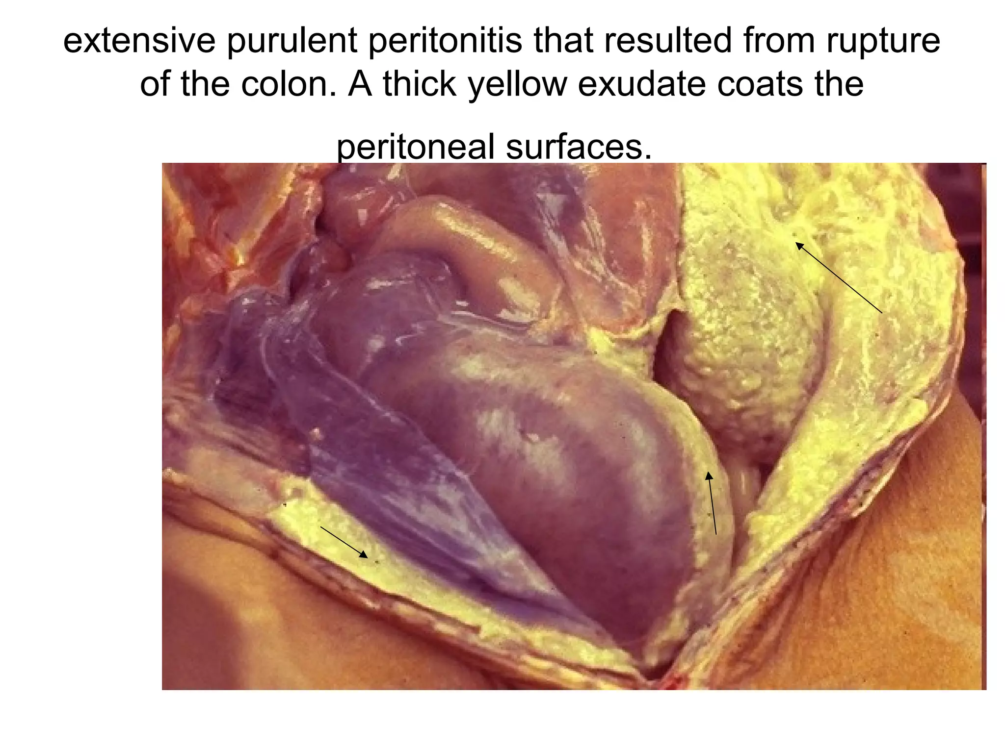 numerous neutrophils fill the alveoli in this case of
acute bronchopneumonia
 