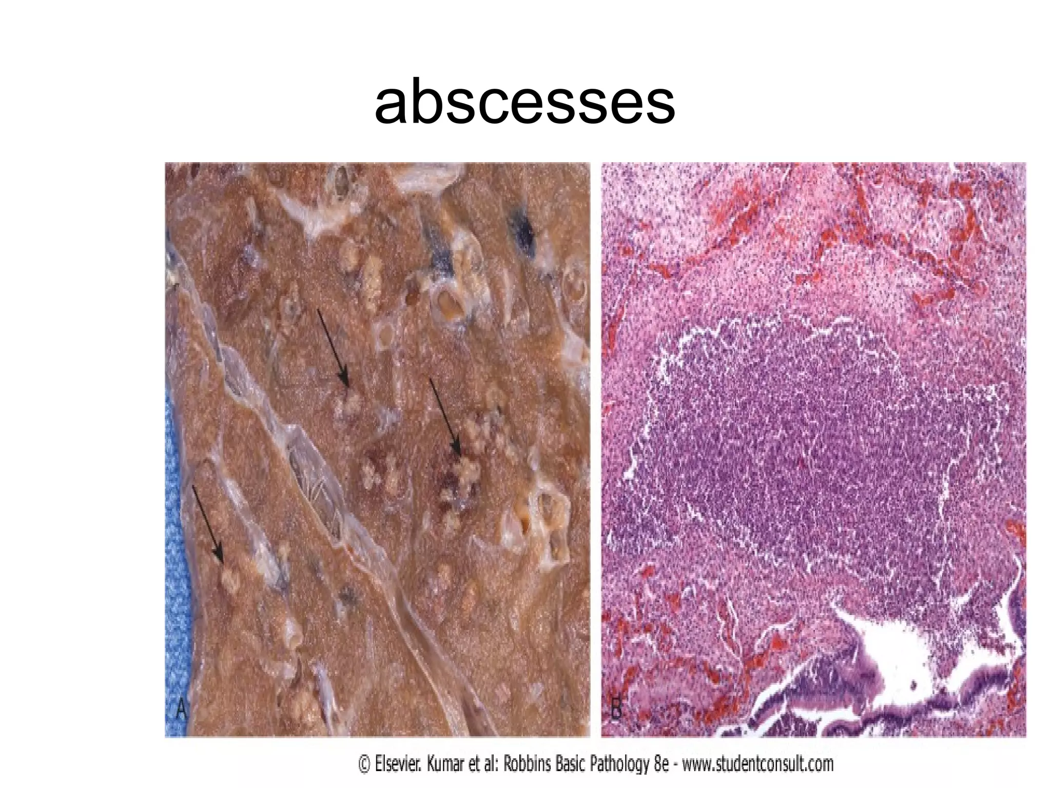The arm at the botton is swollen(edematous) &
reddened(erythematous)
 