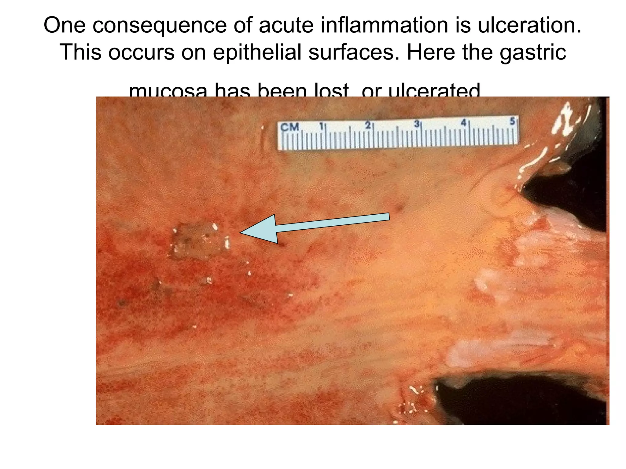 fibrin mesh in fluid with PMN's that has formed in the
area of acute inflammation.
 