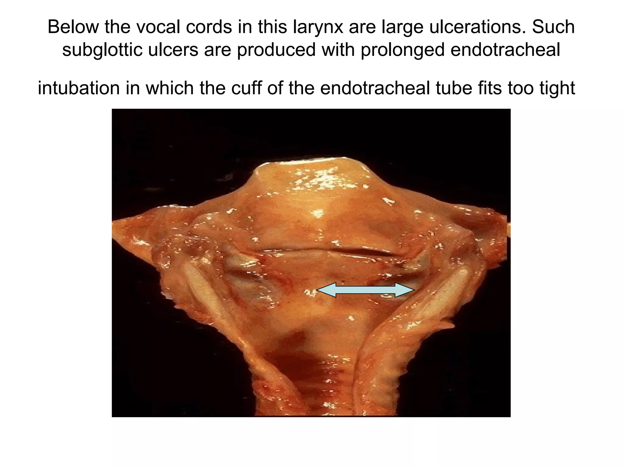 PMN's that are marginated along the dilated venule wall (arrow)
are squeezing through the basement membrane (the process of
diapedesis) and spilling out into extravascular space.
 