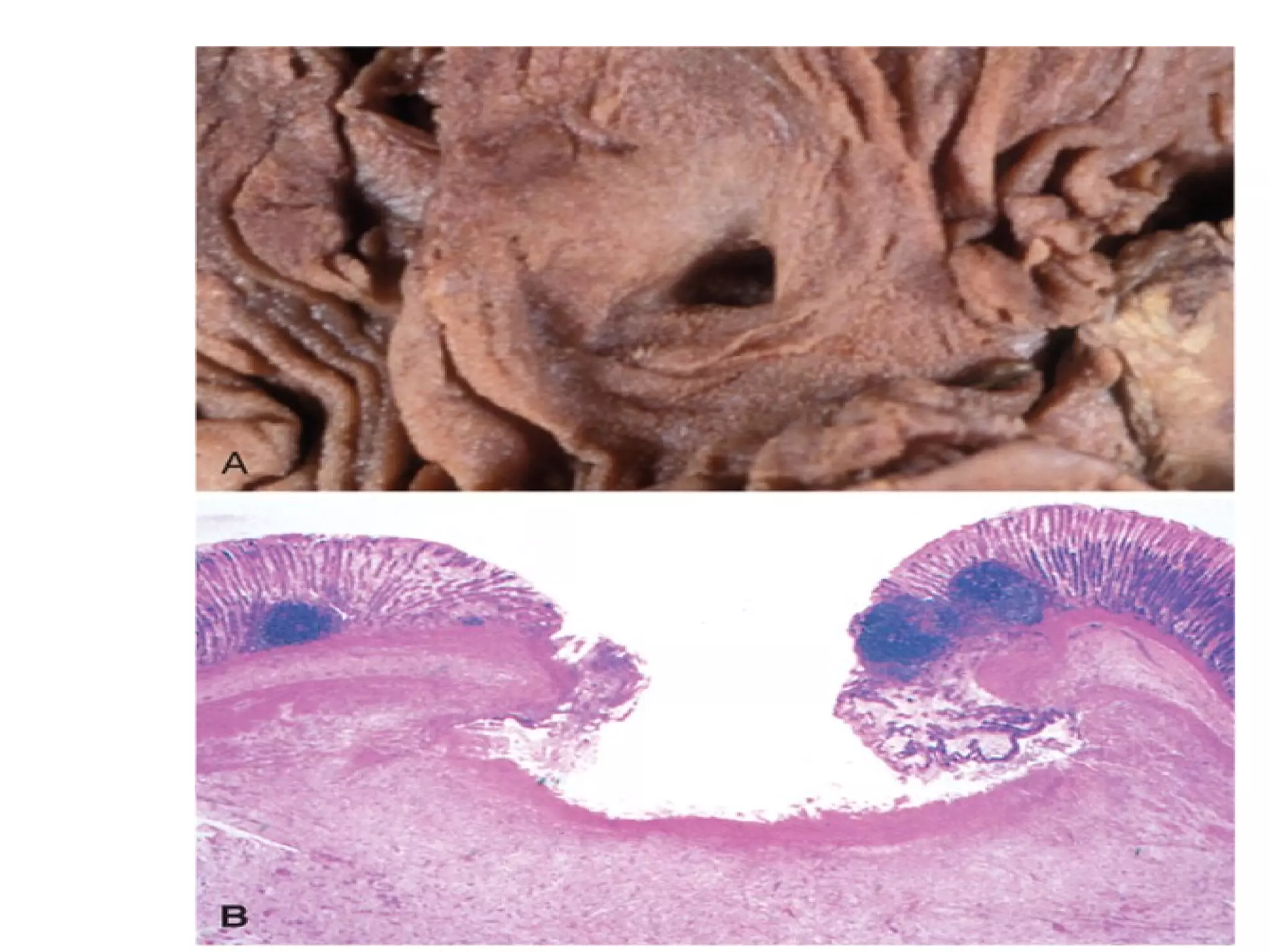 Pleural effusion (serous)
 