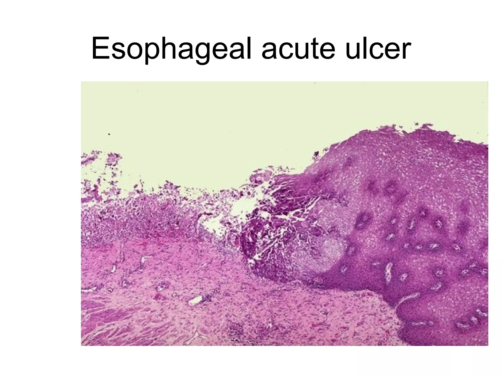 Pleural
effusion(serosanguinous)
 