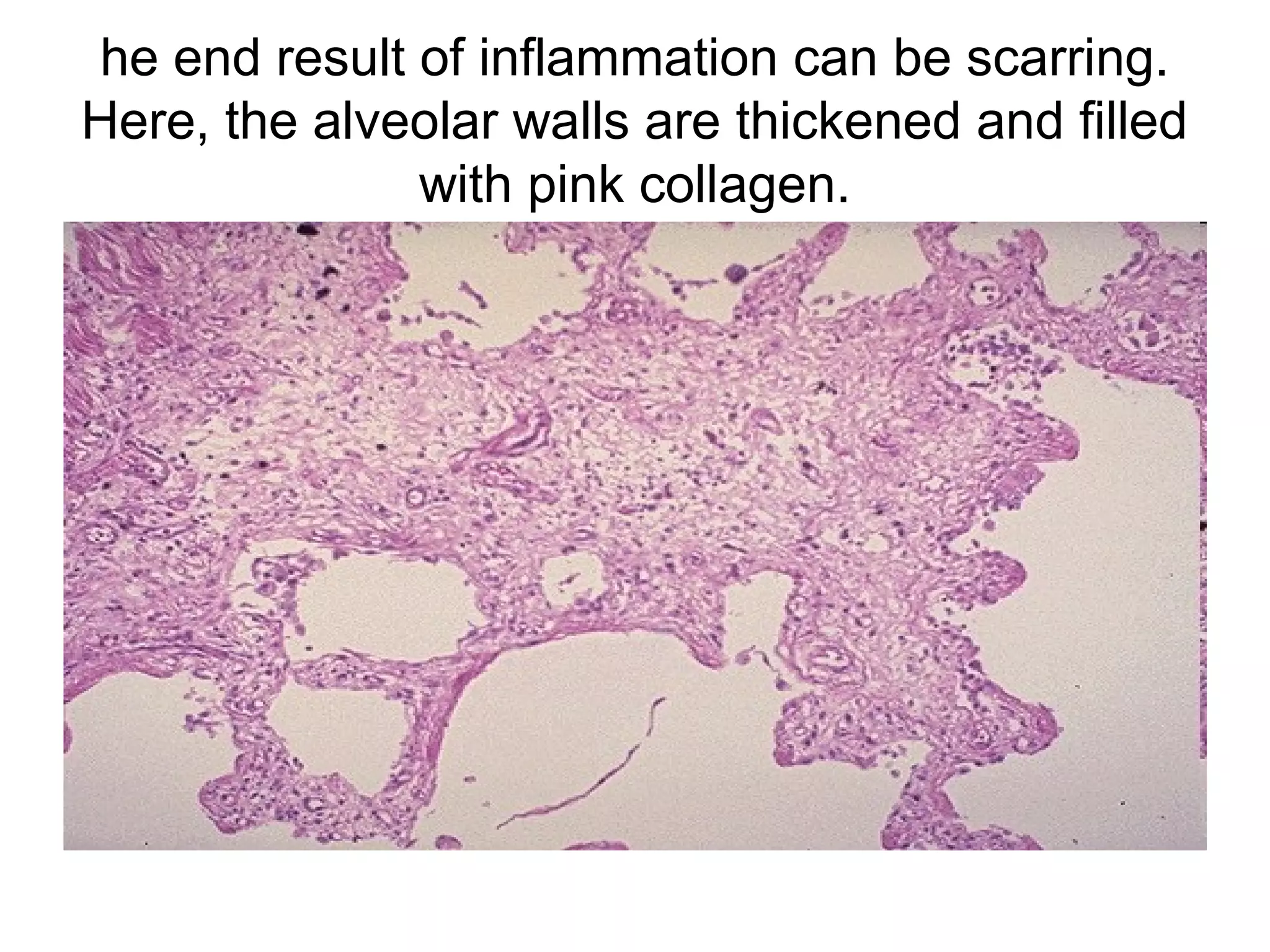 purulent exudate in pericardium
 