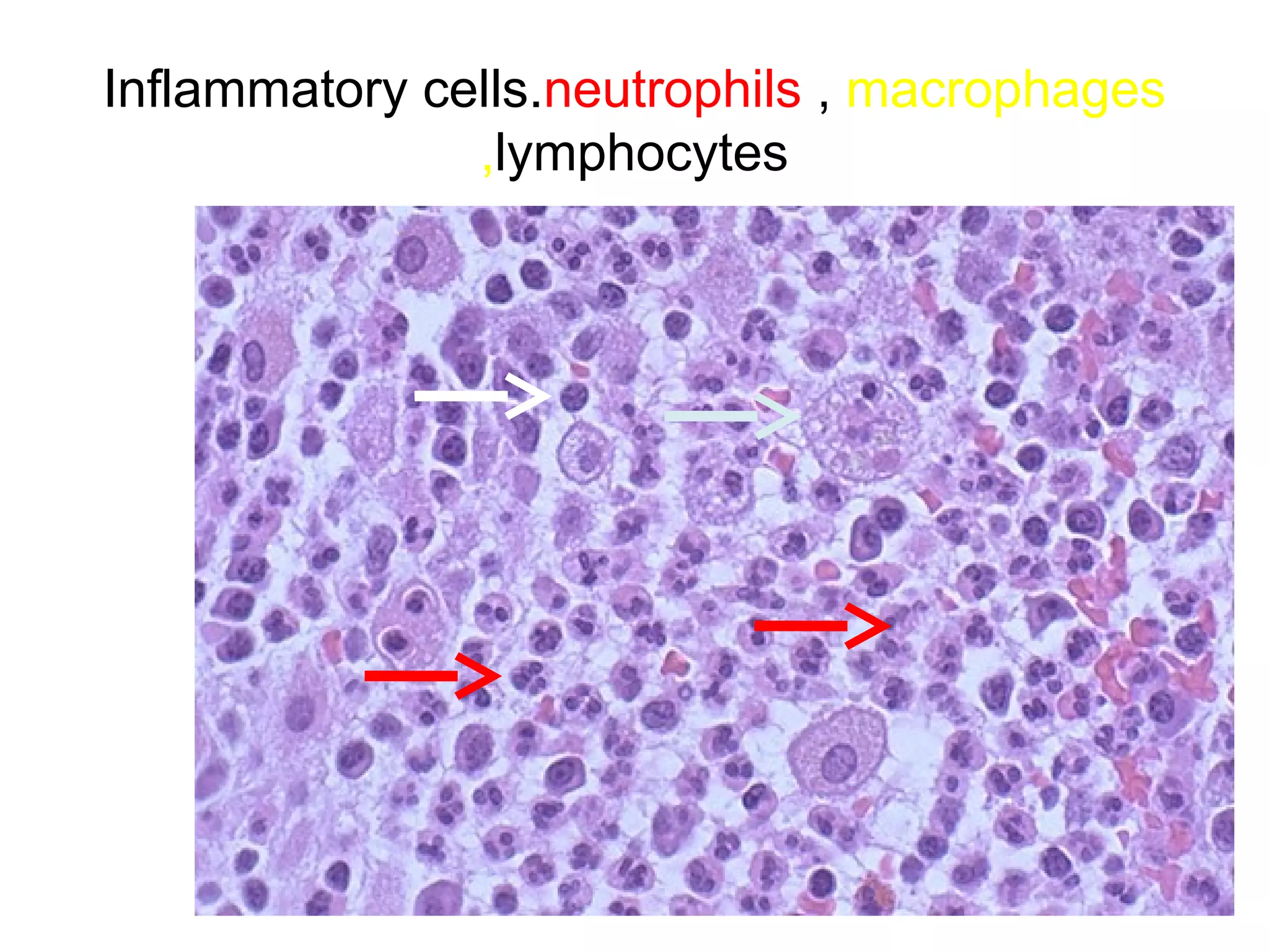 Many cells have died that
the tissue is not
recognizable. Many nuclei
have become pyknotic
(shrunken and dark) and
have then undergone
karorrhexis
(fragmentation) and
karyolysis (dissolution).
The cytoplasm and cell
borders are no longer
recognizable. In this case,
loss of the blood supply
from a major coronary
artery led to ischemia and
cell death.
 