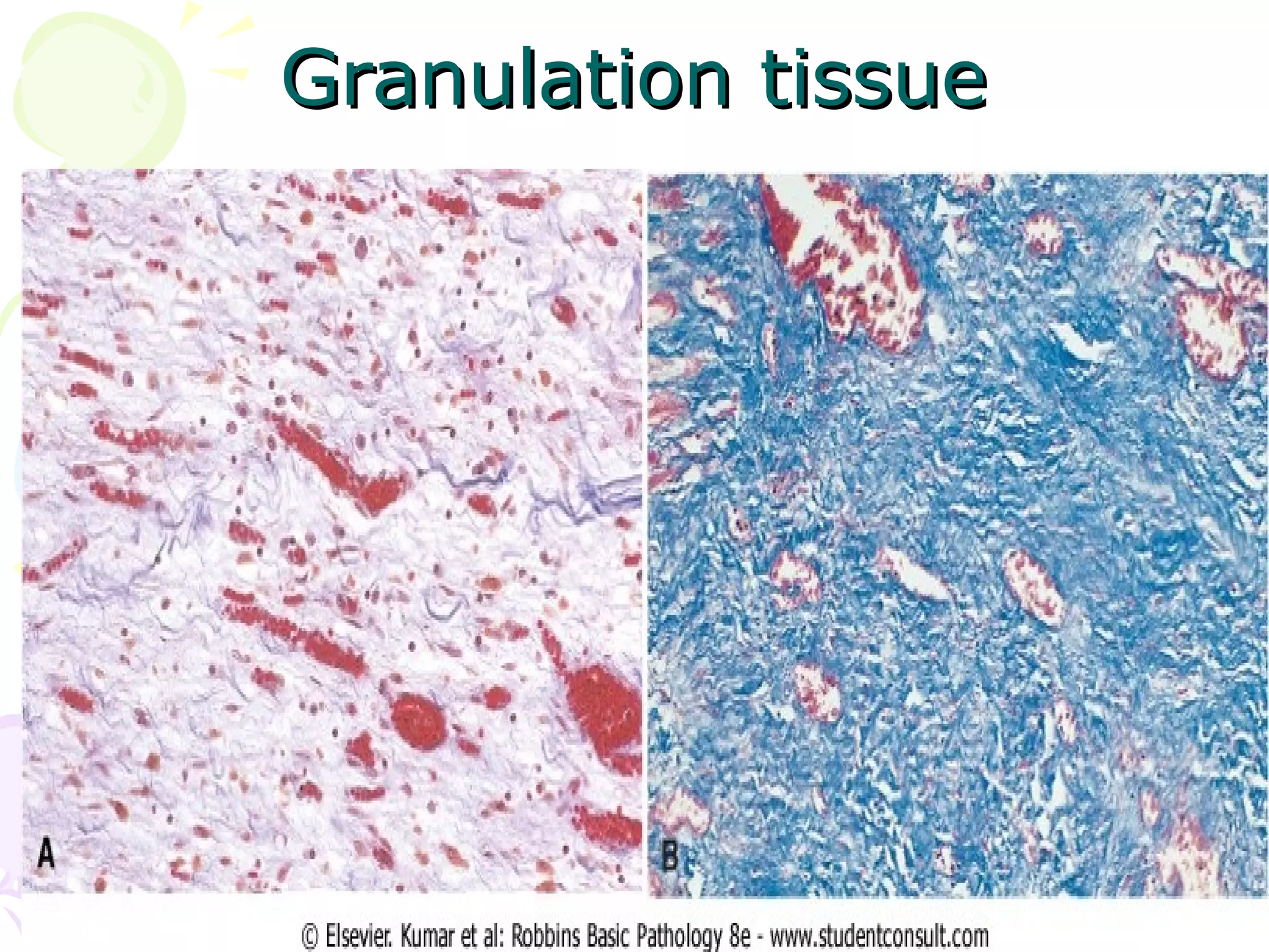 Serous acute inflammation
 