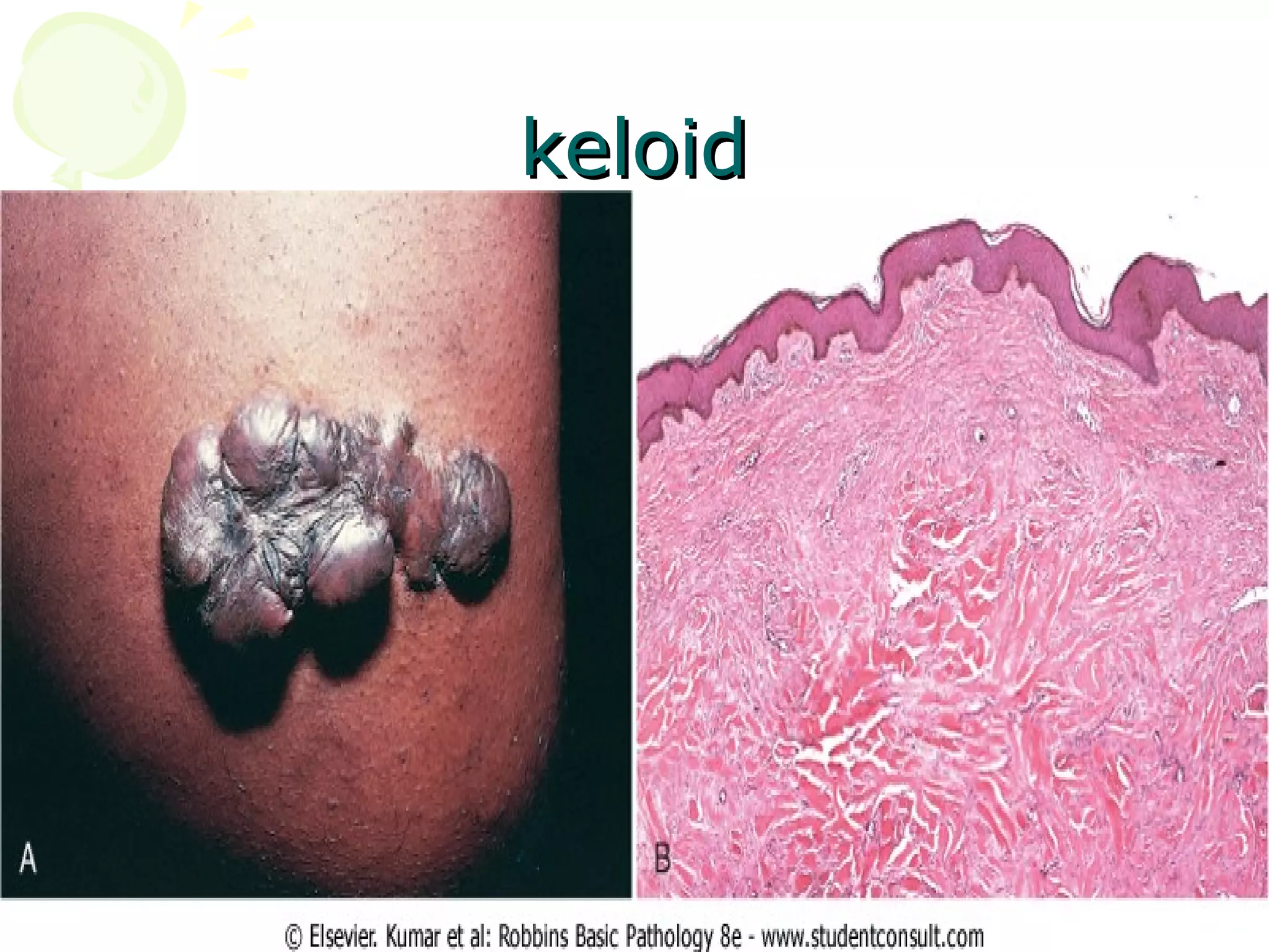 Fibrinous pericarditis
 