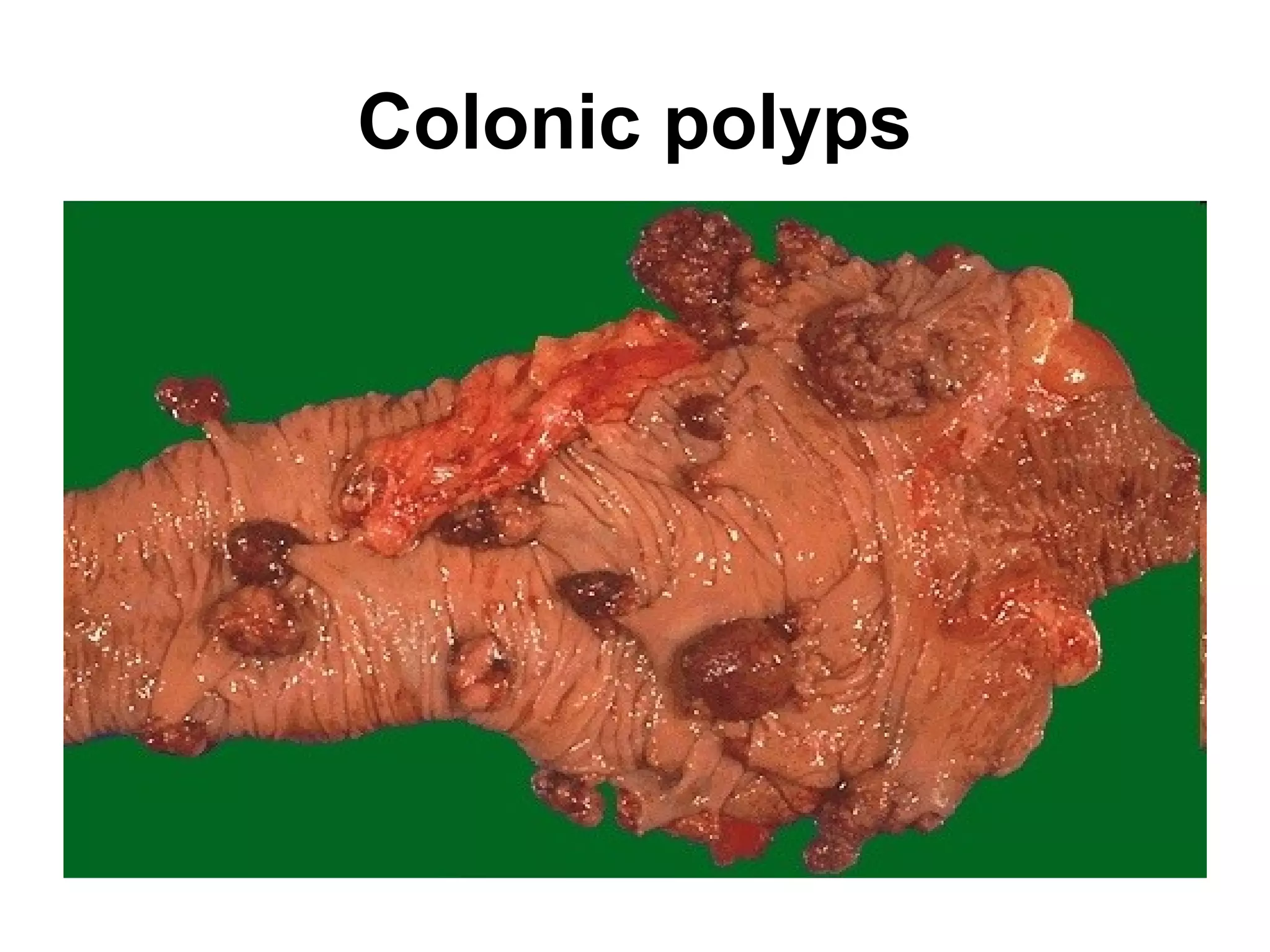 Microscopically, the fibrinous exudate is seen to
consist of pink strands of fibrin jutting from the
pericardial surface(arrows). Below this, there are a few
scattered inflammatory cells.
 