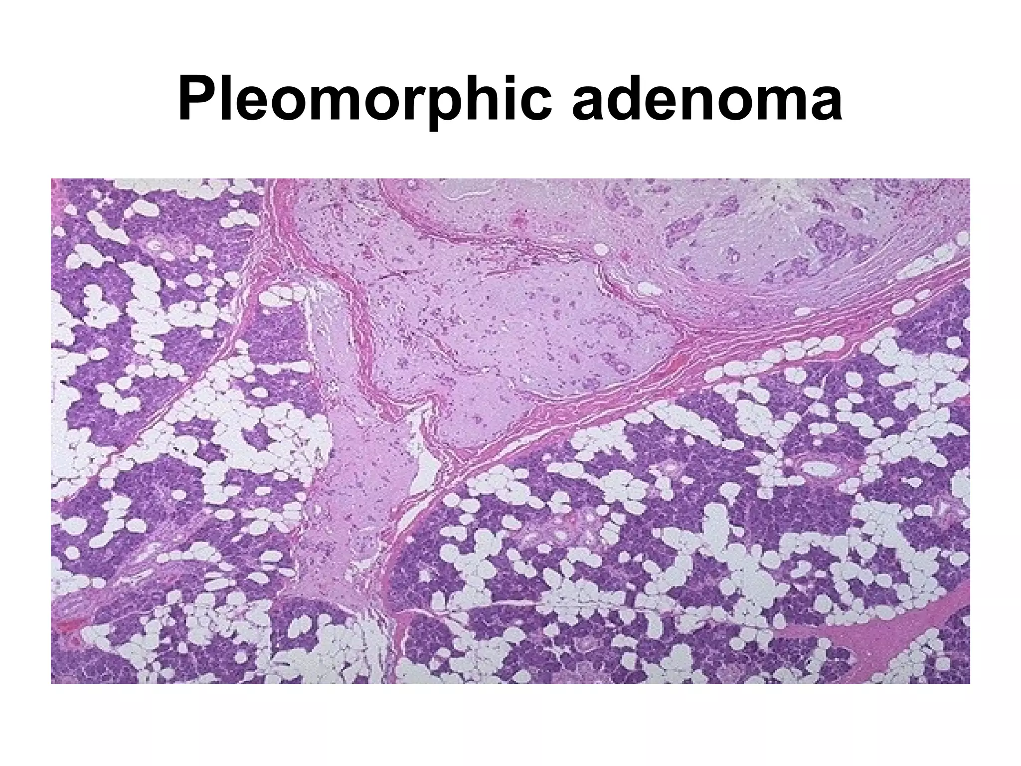 A purulent exudate is seen beneath the meninges in the brain of
this patient with acute meningitis from Streptococcus
pneumoniae infection. The exudate obscures the sulci.
 