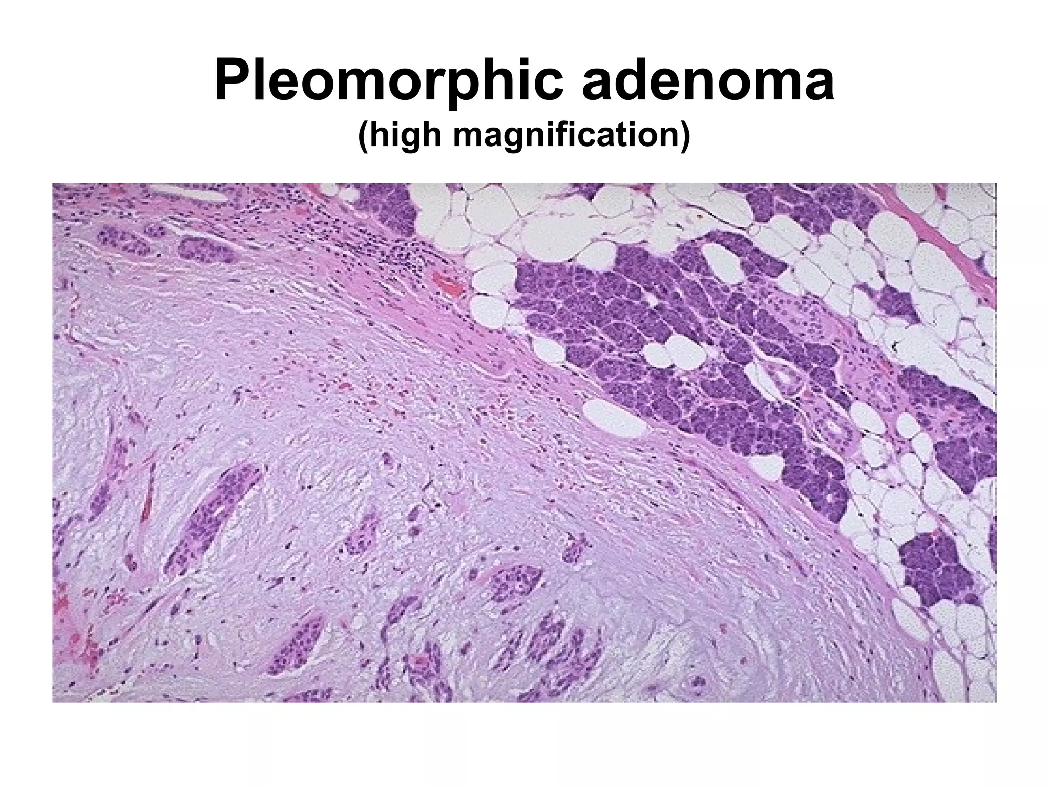extensive purulent peritonitis that resulted from rupture
of the colon. A thick yellow exudate coats the
peritoneal surfaces.
 