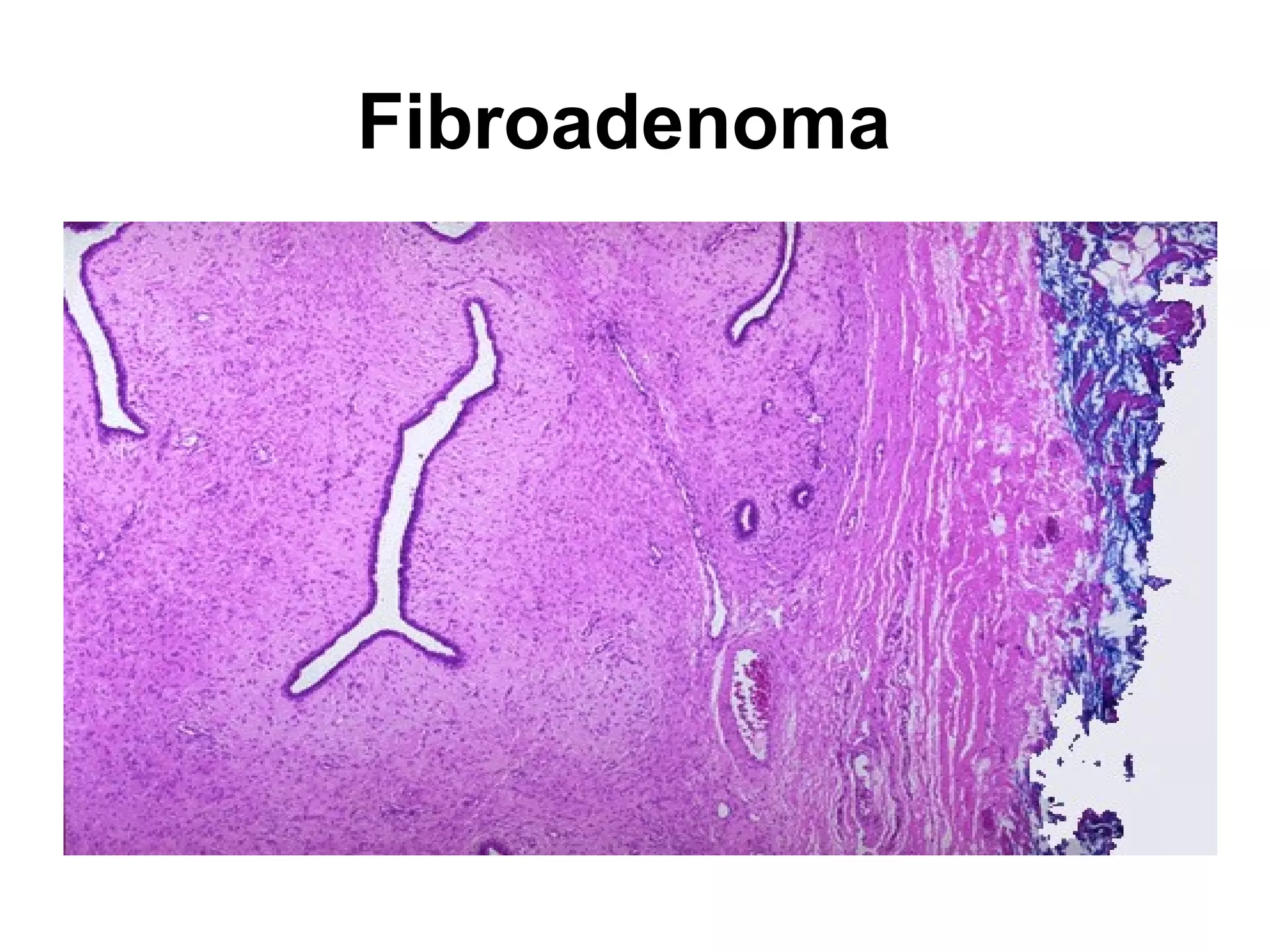 The white arrows mark areas of abscess formation in the upper
lobe of this lung. The liquefactive necrosis of an abscess is
apparent, because the purulent contents are draining out to
leave a cavity.
 