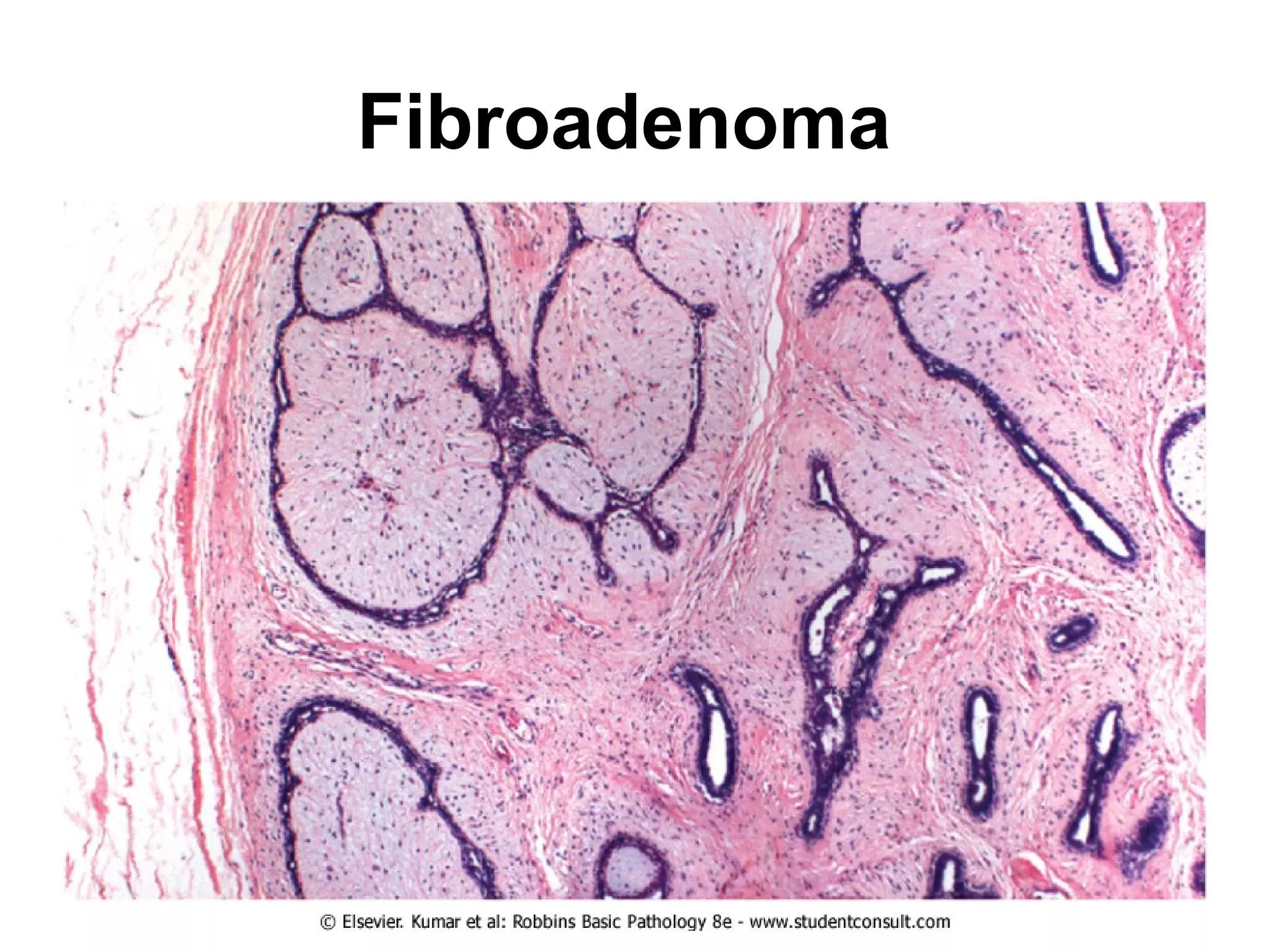 focal abscess in the lung. The
alveoli in that area have been
destroyed.
 