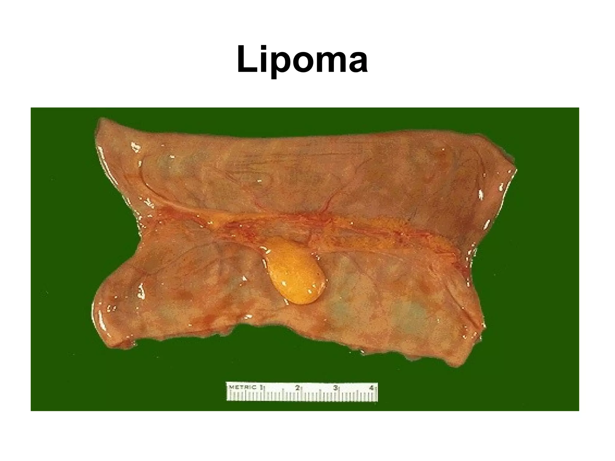 One consequence of acute inflammation is ulceration.
This occurs on epithelial surfaces. Here the gastric
mucosa has been lost, or ulcerated.
 