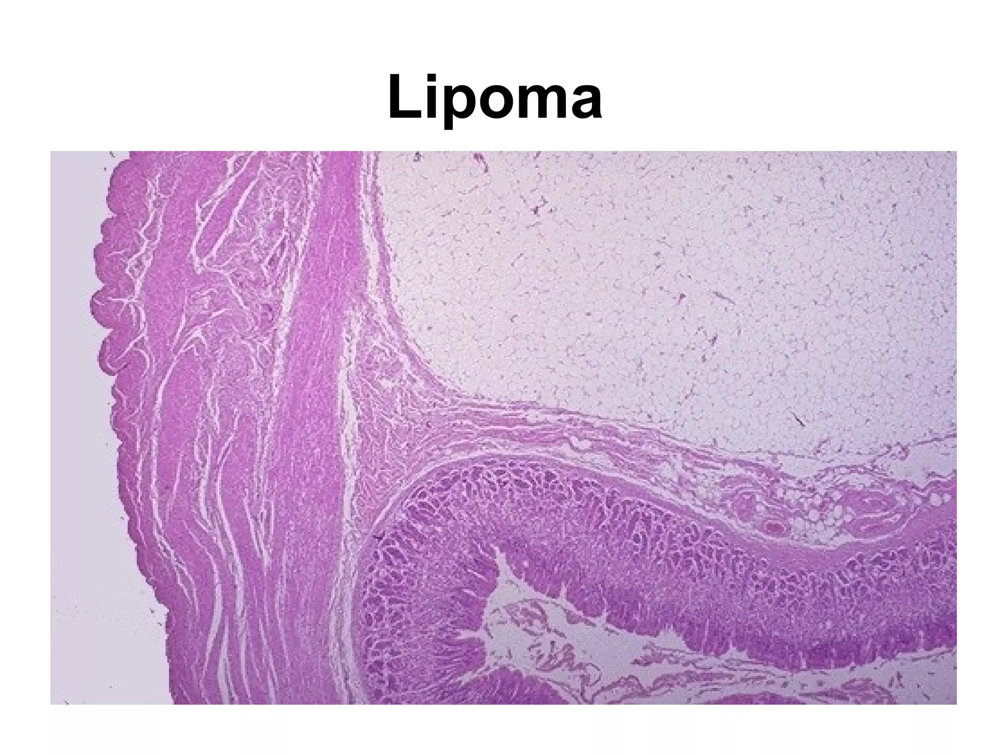 Below the vocal cords in this larynx are large ulcerations. Such
subglottic ulcers are produced with prolonged endotracheal
intubation in which the cuff of the endotracheal tube fits too tight
 