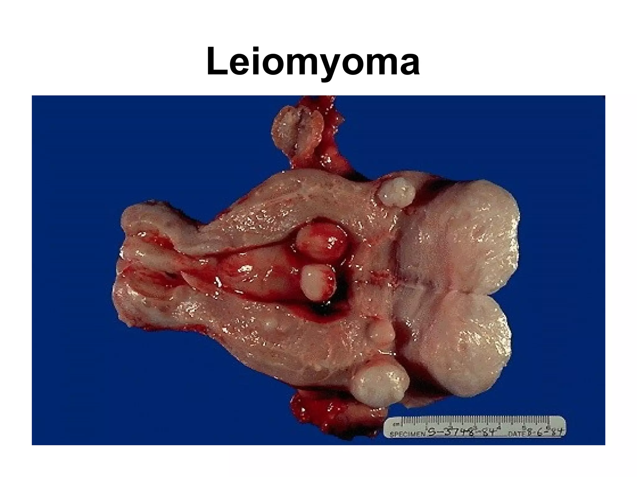Esophageal acute ulcer
 