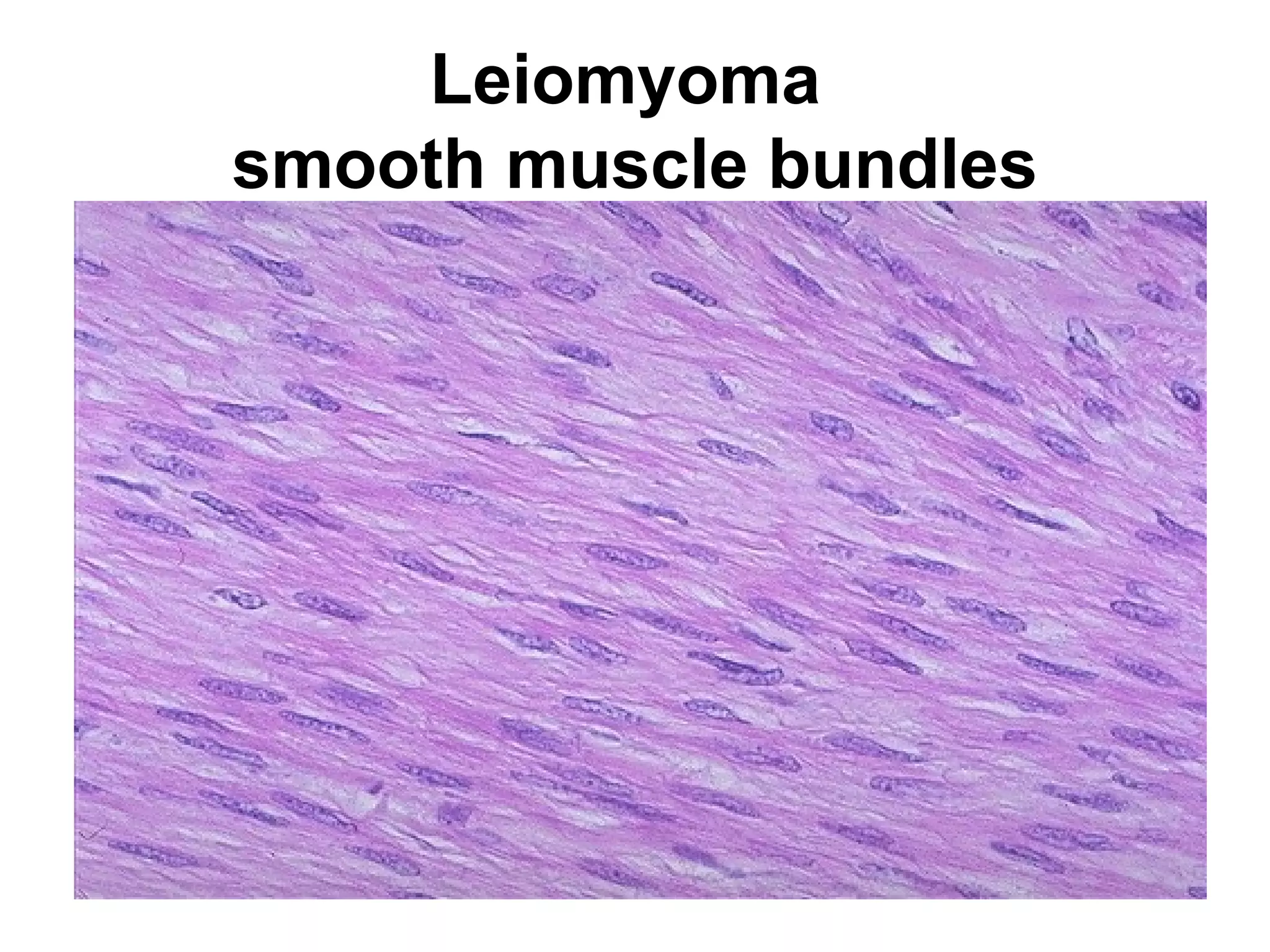 he end result of inflammation can be scarring.
Here, the alveolar walls are thickened and filled
with pink collagen.
 