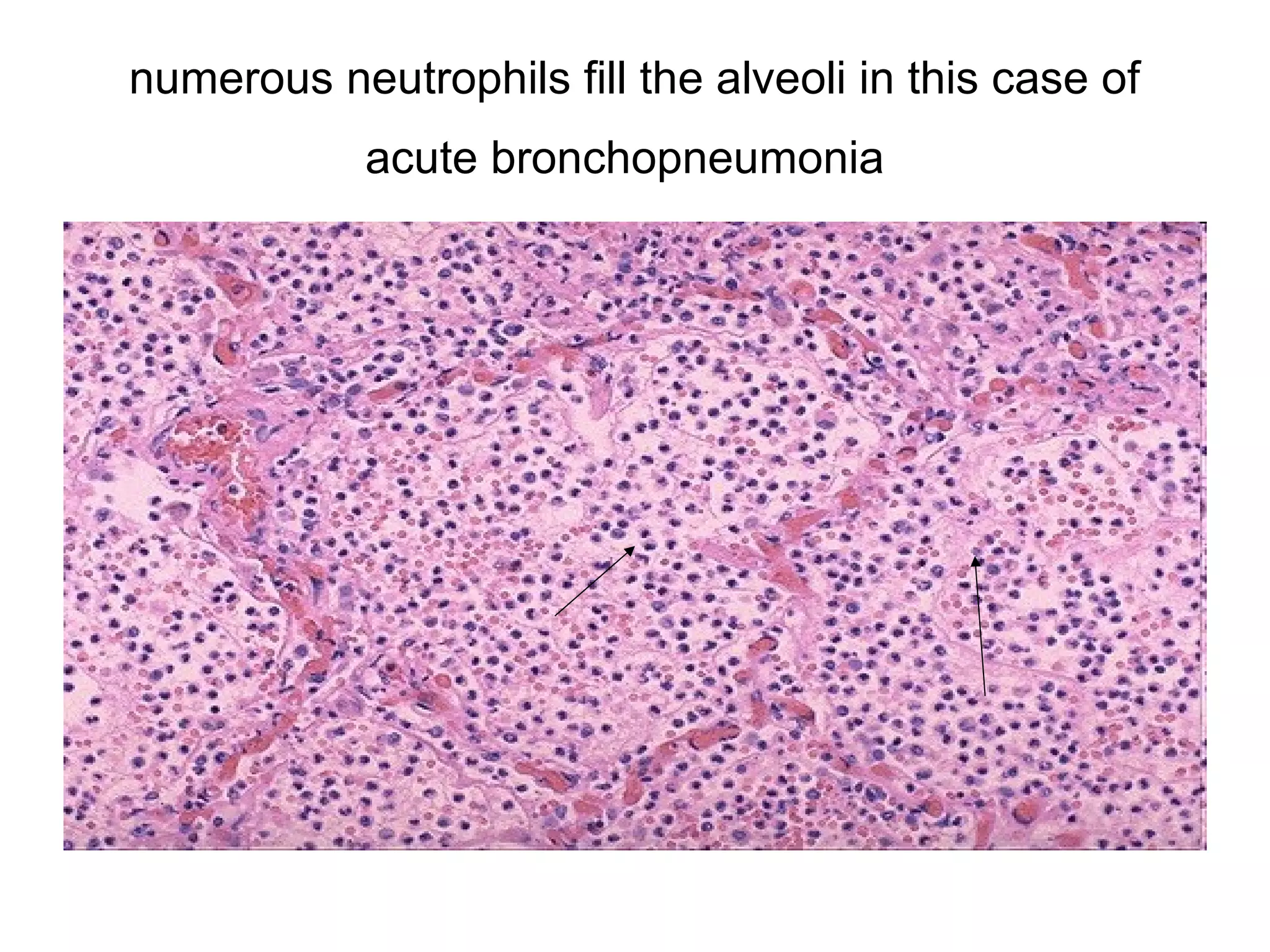 In these images you can see this preservation of architecture: this is quite recognizably liver,
despite the absence of nuclei in the hepatocytes in the affected area. Notice the thread-like
bacteria present in the sinusoids: these are the organism causing the lesion! Darker staining
viable hepatocytes are visible around the portal regions (right) and pale, necrotic hepatocytes are
visible in the central lobular zones. Hepatocytes near the blood supply have more physiologic
reserve and will be more able to fend off the infection than those in the oxygen and nutrient-poor
central region: but in this case the "advantage" is moot.
 