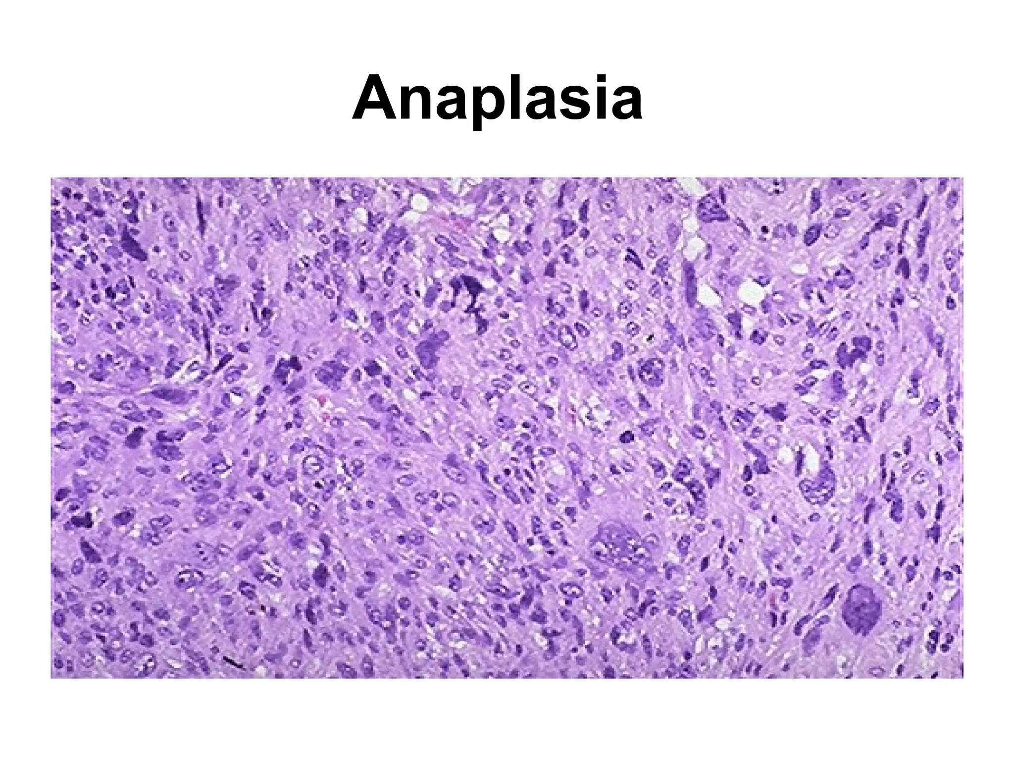 Colonic polyps
(adenoma)
 
