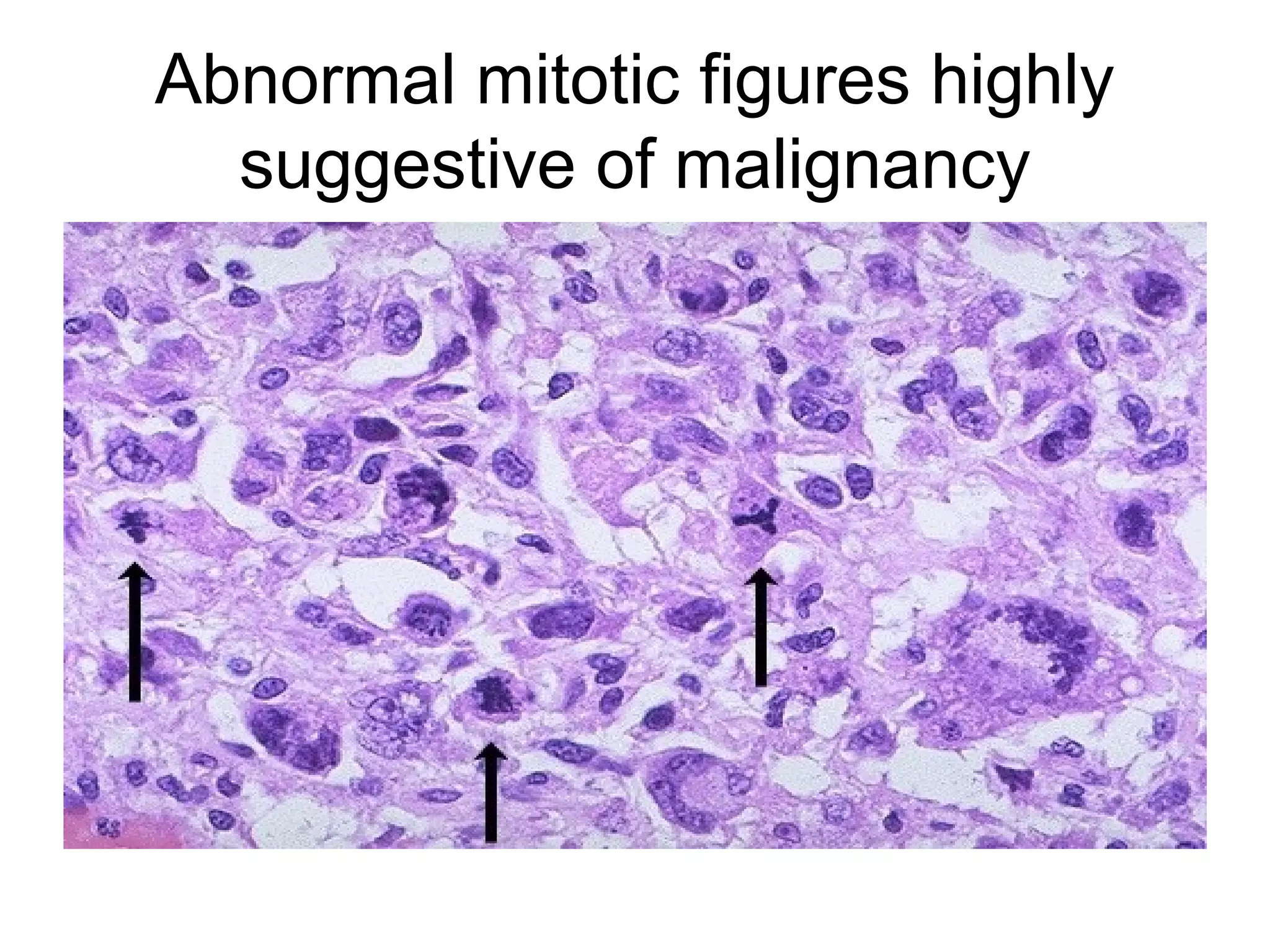 Pleomorphic adenoma
(high magnification)
 
