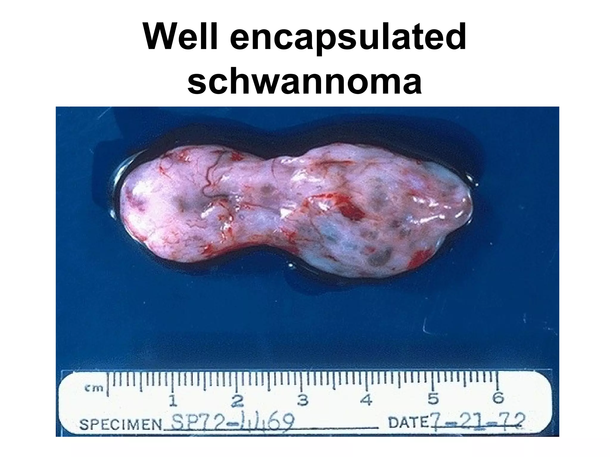 Fibroadenoma
 