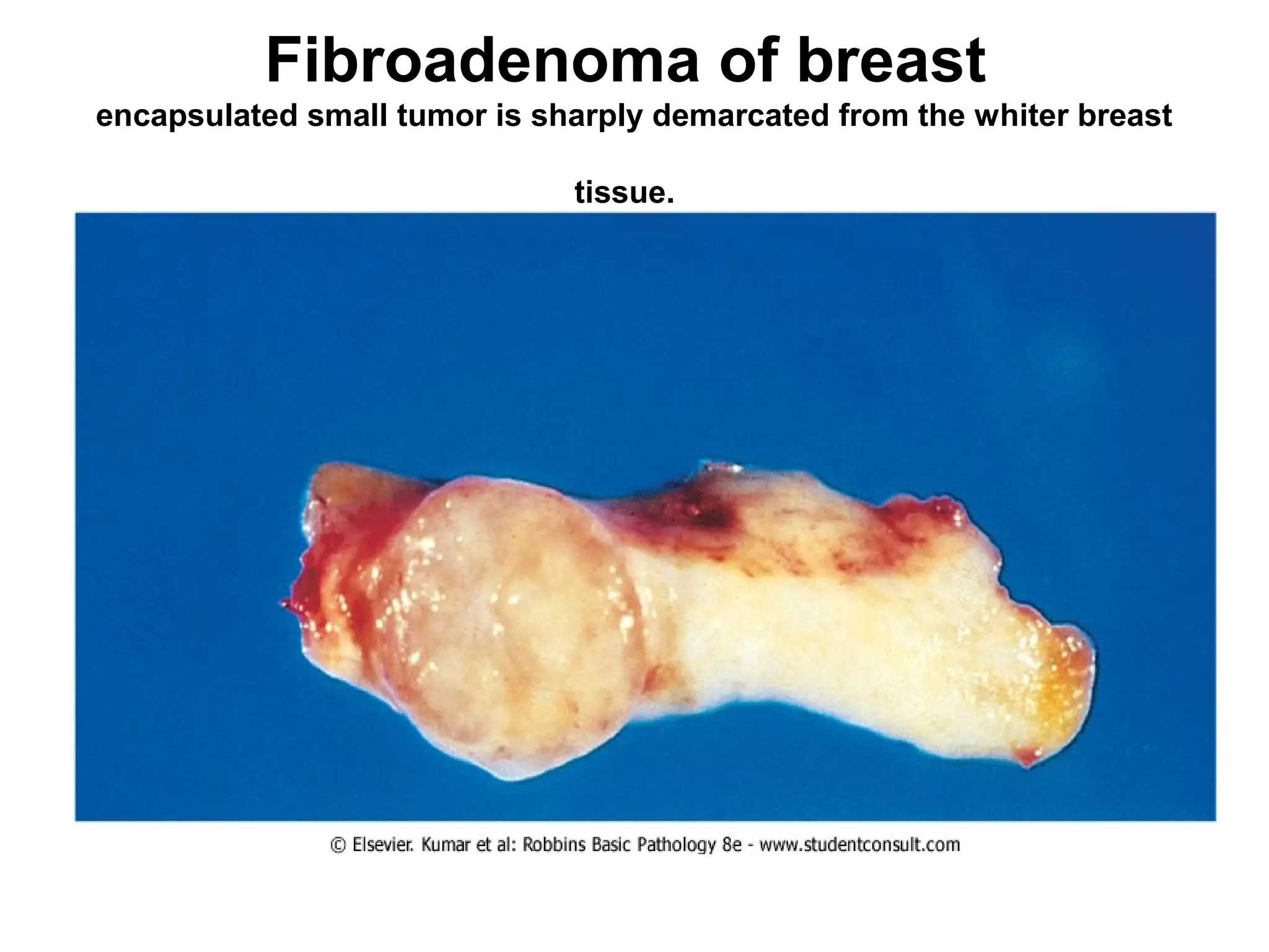 Mature adipose tissue
(lipoma)
 