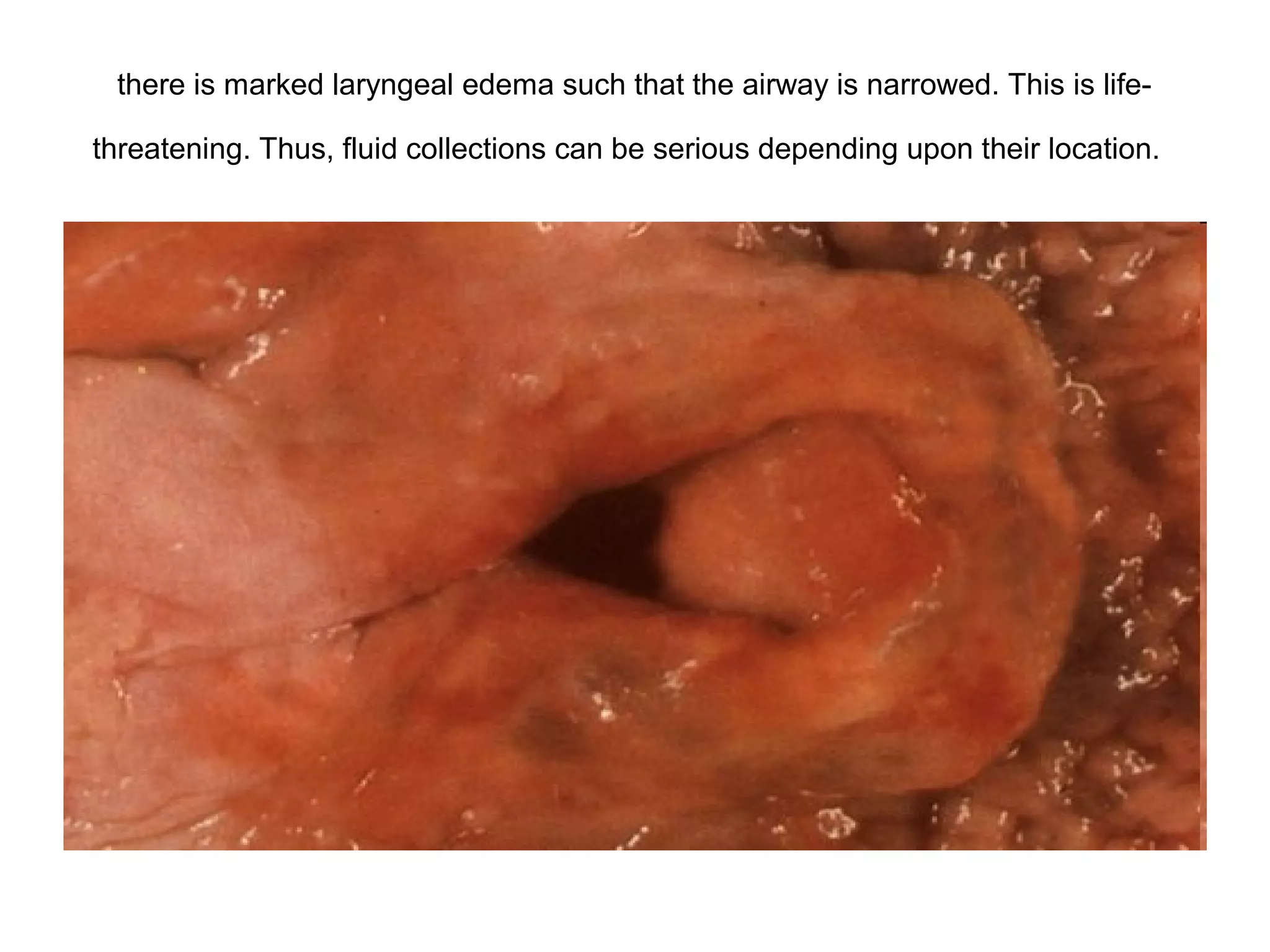 Caseous necrosis and granulomatosis
 