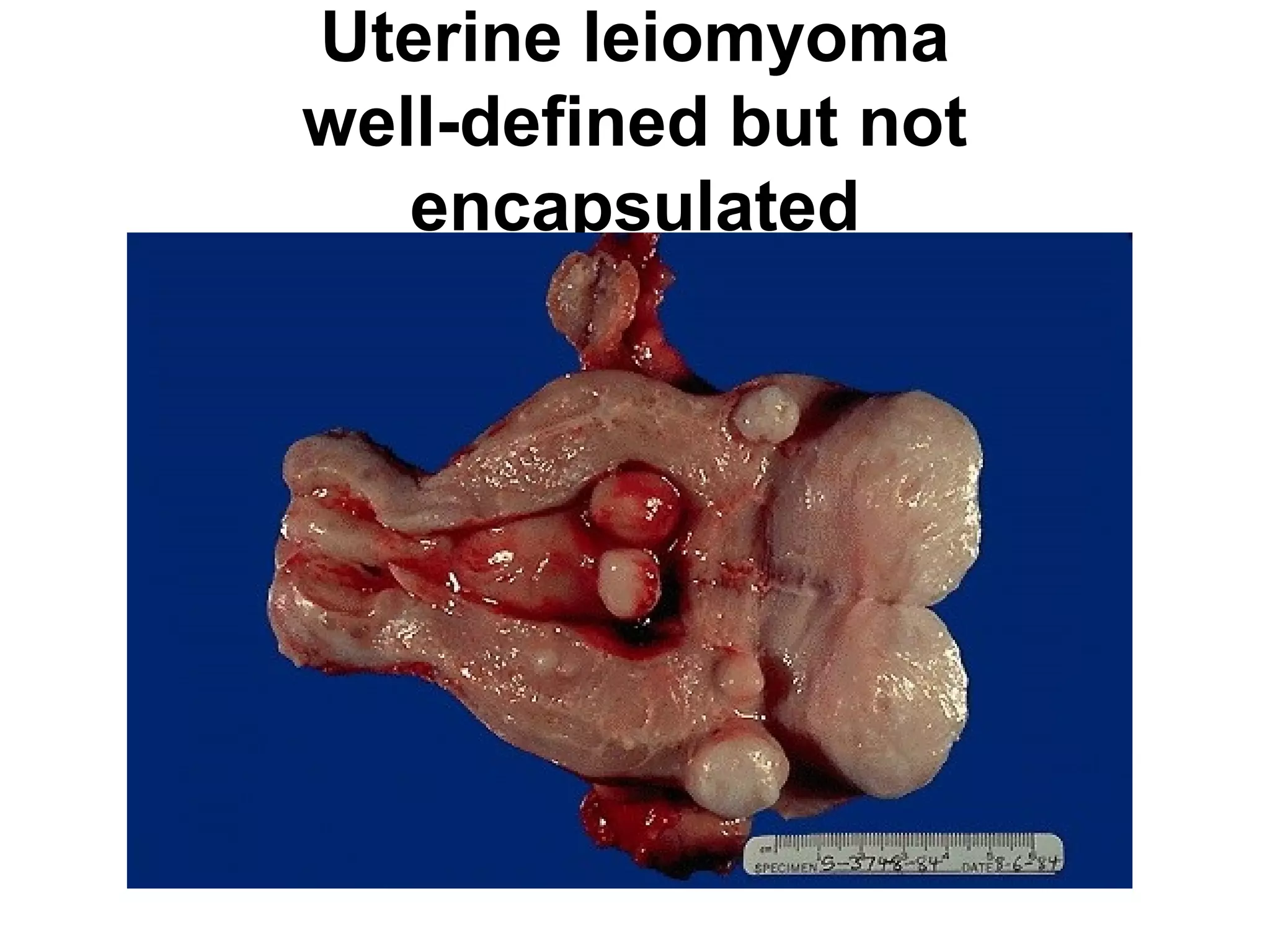 Leiomyoma
 