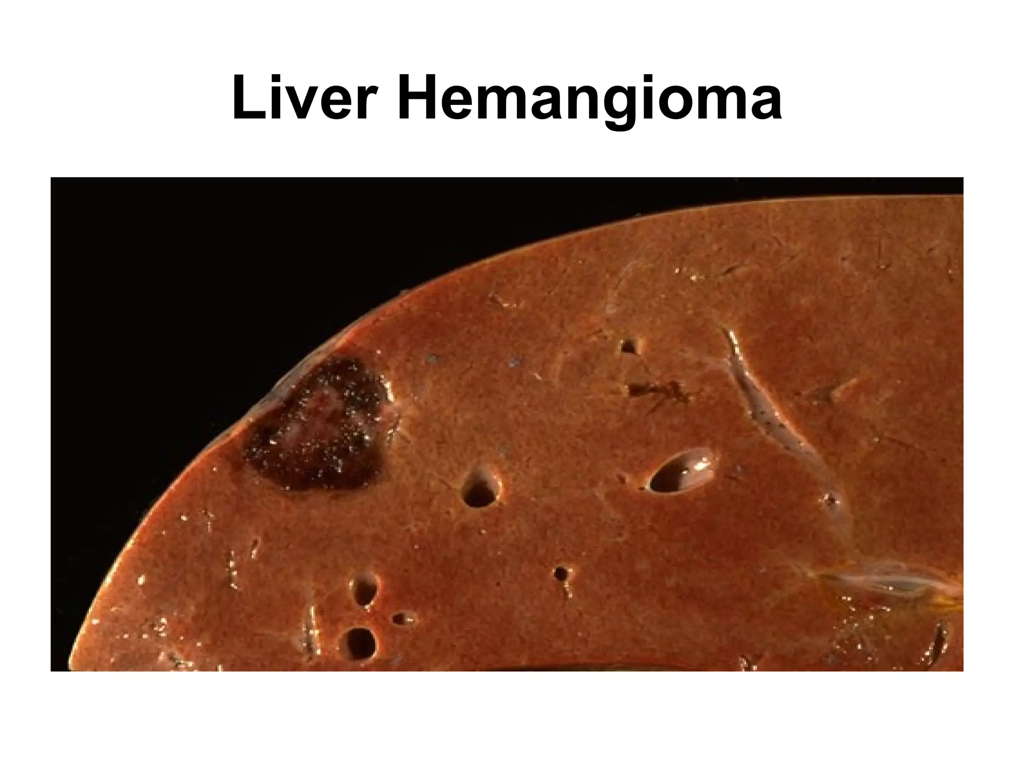 Leiomyoma
smooth muscle bundles
 