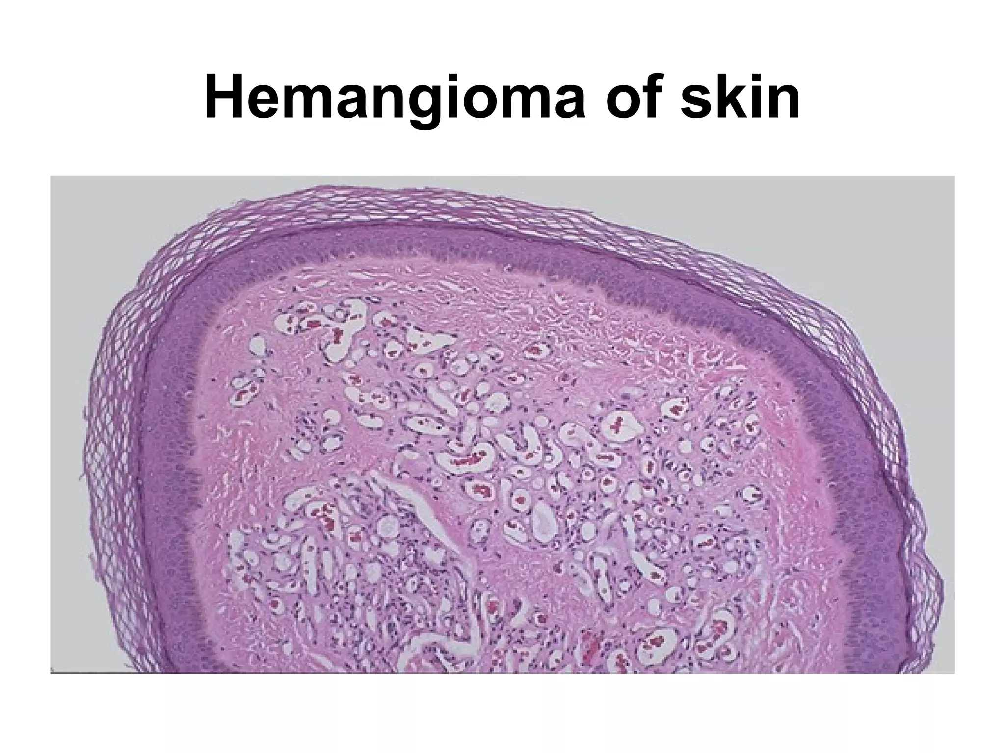 Well differentiated squamous
cell carcinoma (keratin
formation-arrow)
 