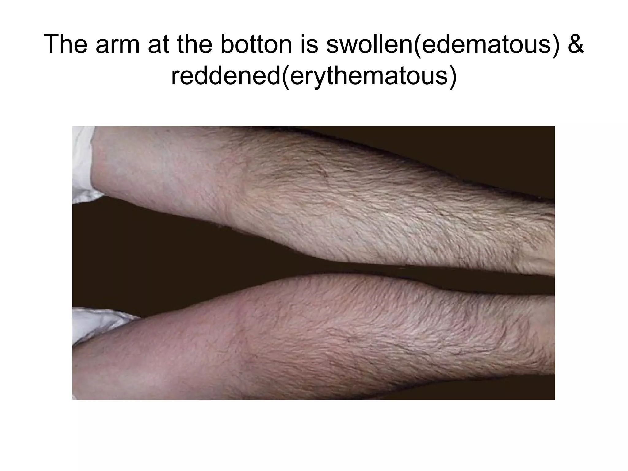 Figure 7.11 Fat necrosis, ordinary type. Multinucleated histiocytic giant cells surround a
large lipid vacuole formed by fusion of destroyed adipocytes. Scattered lymphocytes and
monocytes occupy expanded spaces between cells at top.
 