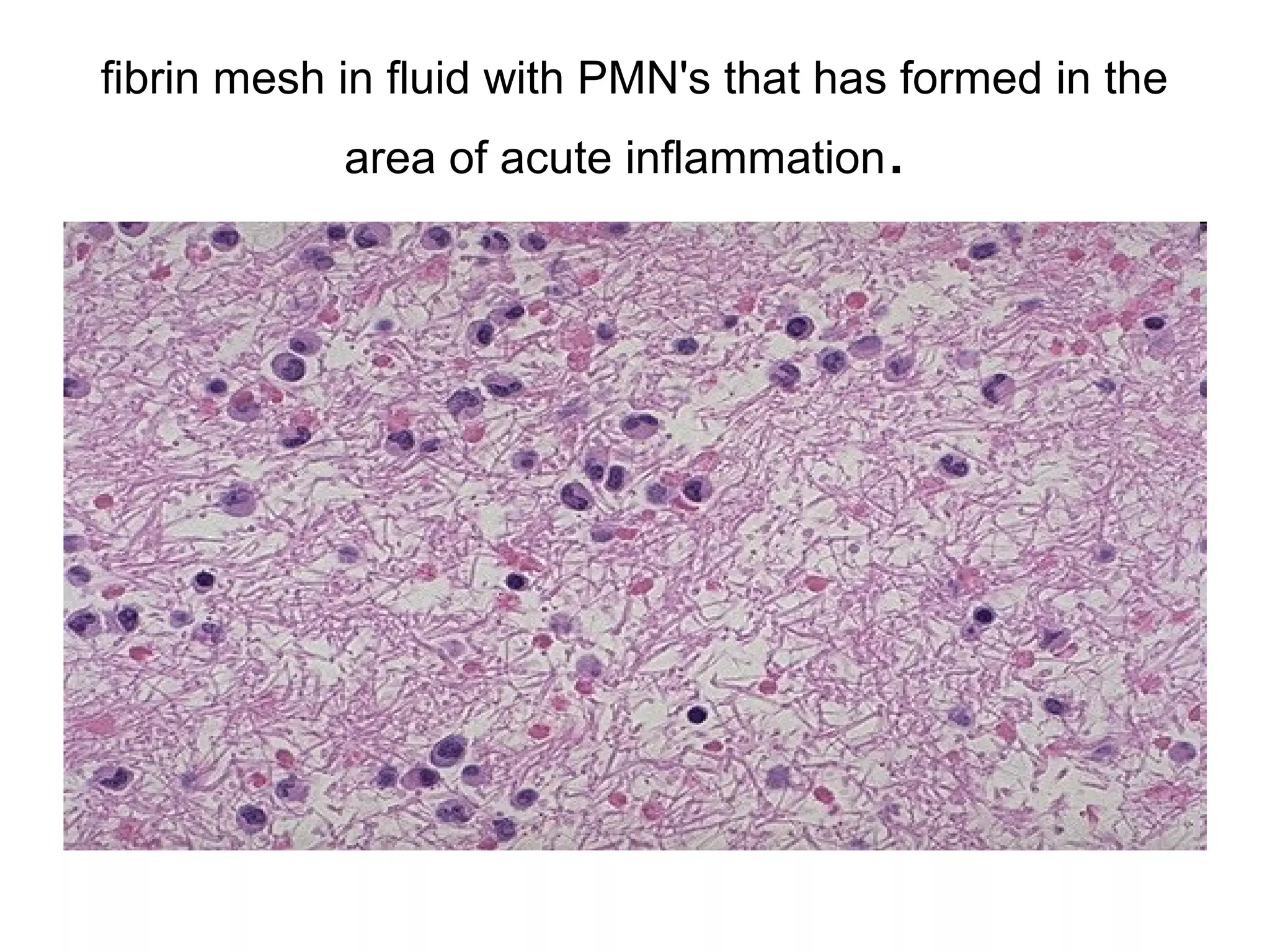 Intracellular accumulations of a variety of materials can occur in response to cellular
injury. Here is fatty metamorphosis (fatty change) of the liver in which deranged
lipoprotein transport from injury (most often alcoholism) leads to accumulation of lipid in
the cytoplasm of hepatocytes.
 