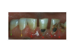 pathology of dental caries part -(1).ppt
