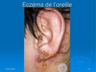 Patho Oreille