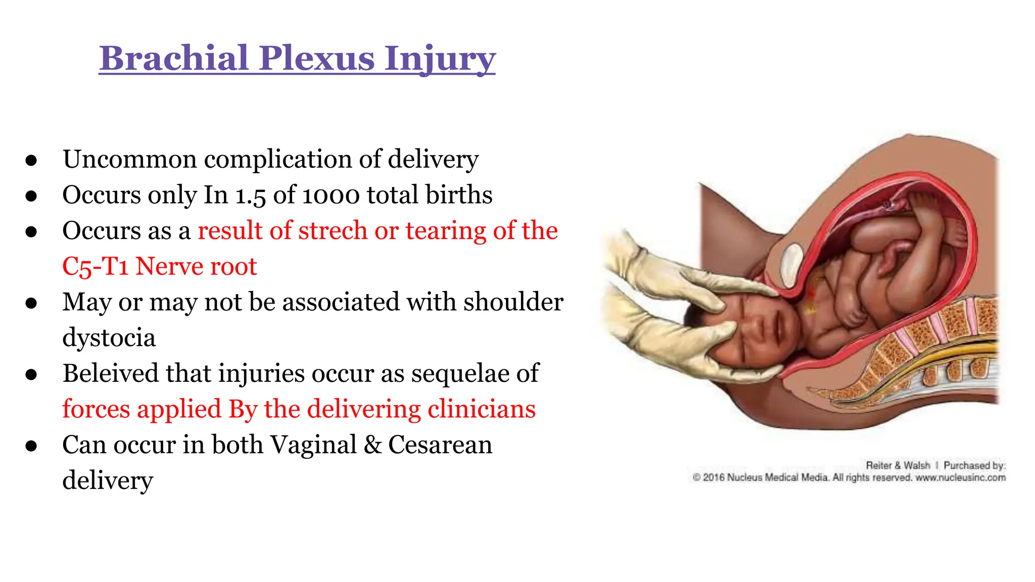 Brachial Plexus Injury
● Uncommon complication of delivery
● Occurs only In 1.5 of 1000 total births
● Occurs as a result of strech or tearing of the
C5-T1 Nerve root
● May or may not be associated with shoulder
dystocia
● Beleived that injuries occur as sequelae of
forces applied By the delivering clinicians
● Can occur in both Vaginal & Cesarean
delivery
 
