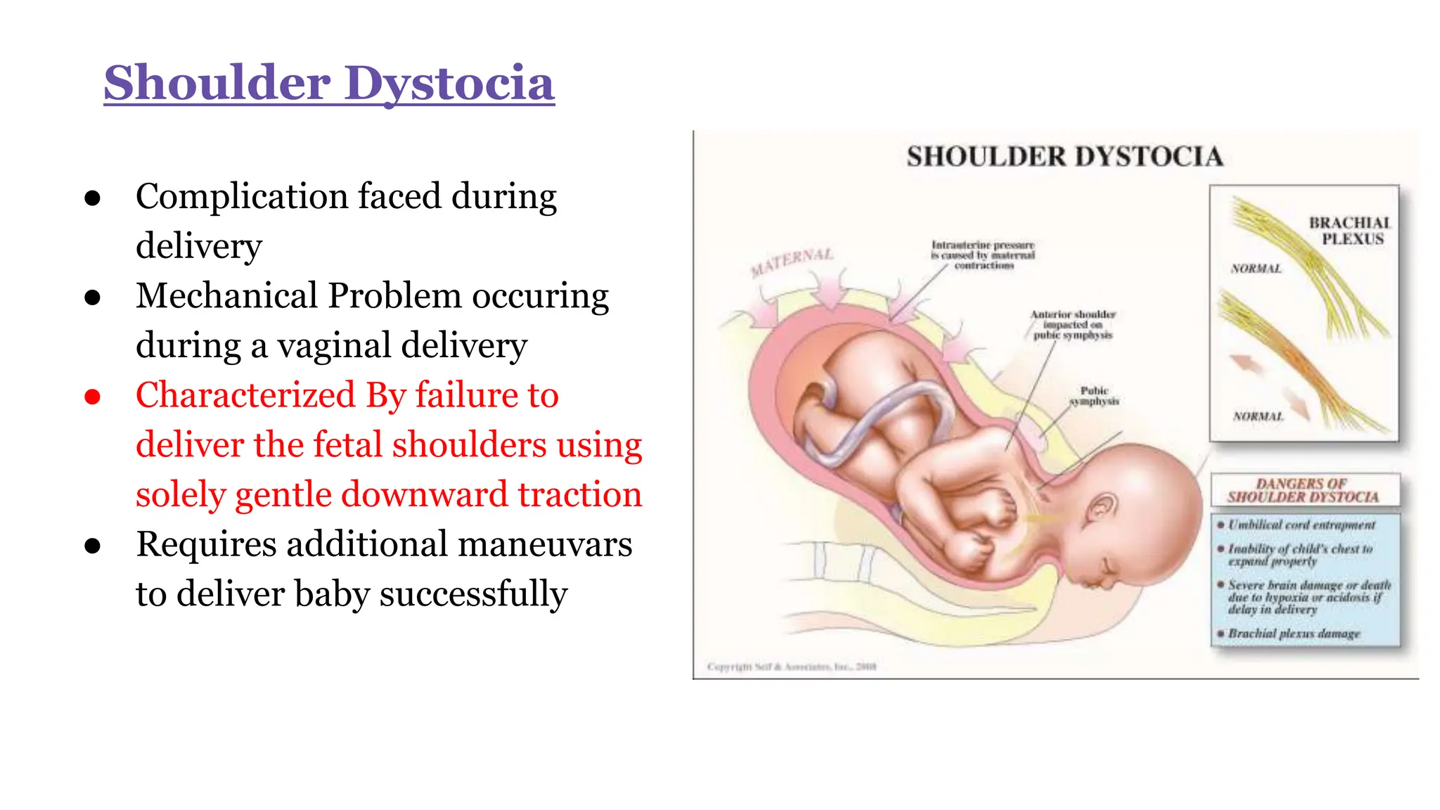 Shoulder Dystocia
● Complication faced during
delivery
● Mechanical Problem occuring
during a vaginal delivery
● Characterized By failure to
deliver the fetal shoulders using
solely gentle downward traction
● Requires additional maneuvars
to deliver baby successfully
 