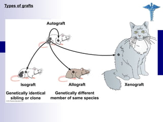 Isograft Examples pathophysiology-140119084712-phpapp01.ppt