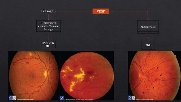 Pathophysiology of Diabetic retinopathy | PPT