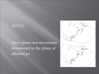  B.P.P.V
 Slow phase eye movement
downward in the plane of
affected pc.
 