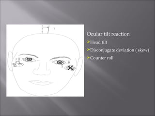 Ocular tilt reaction
Head tilt
Disconjugate deviation ( skew)
Counter roll
 