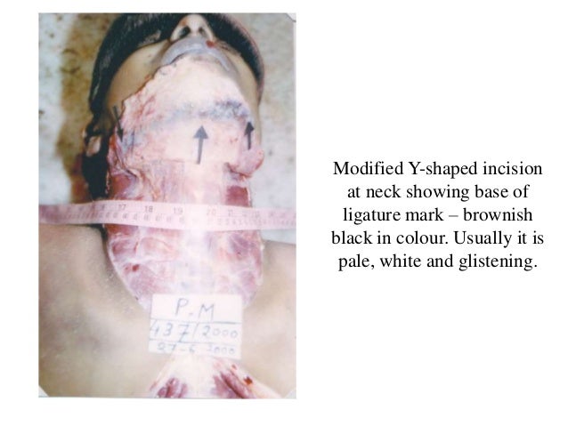 Pathophysiology of asphyxia & drowning