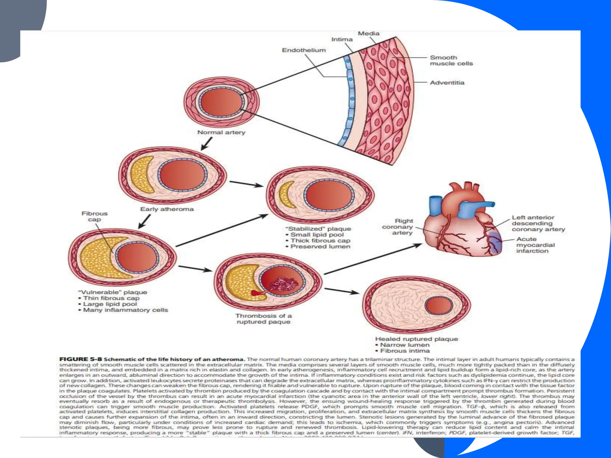 Pathophysiology of atherosclerosis.pptx